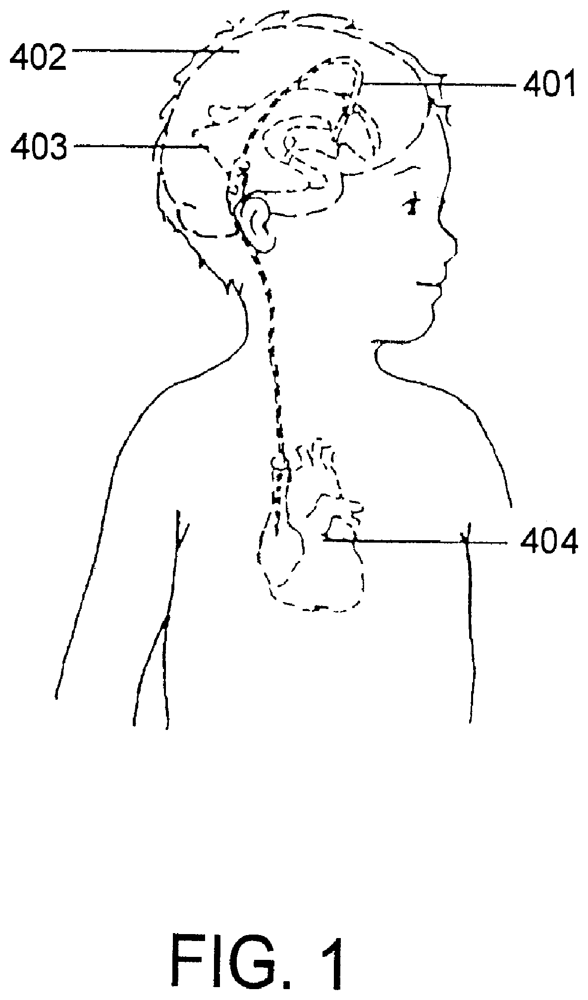 Hydrocephalus shunt arrangement and components thereof for draining cerebrospinal fluid in a patient having hydrocephalus