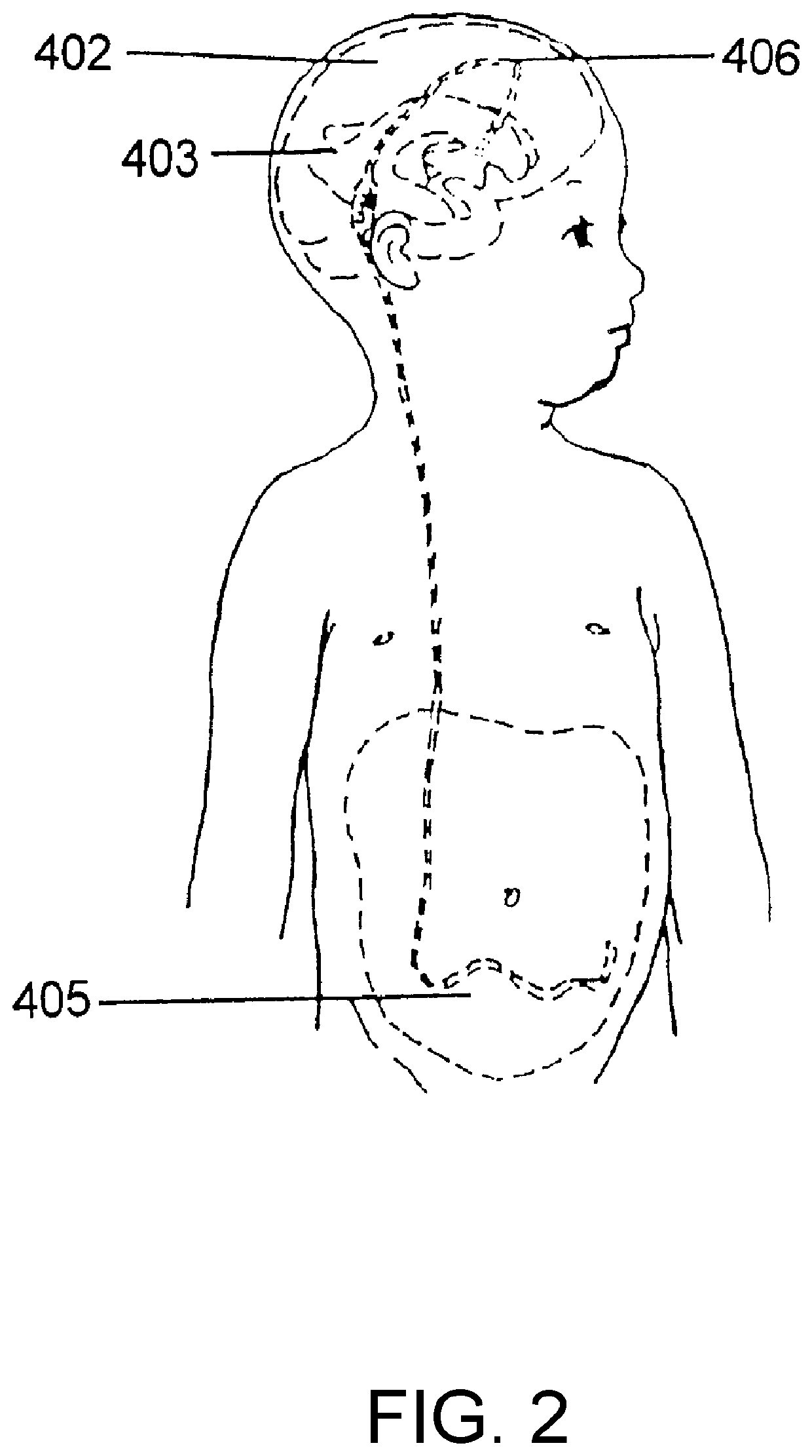 Hydrocephalus shunt arrangement and components thereof for draining cerebrospinal fluid in a patient having hydrocephalus