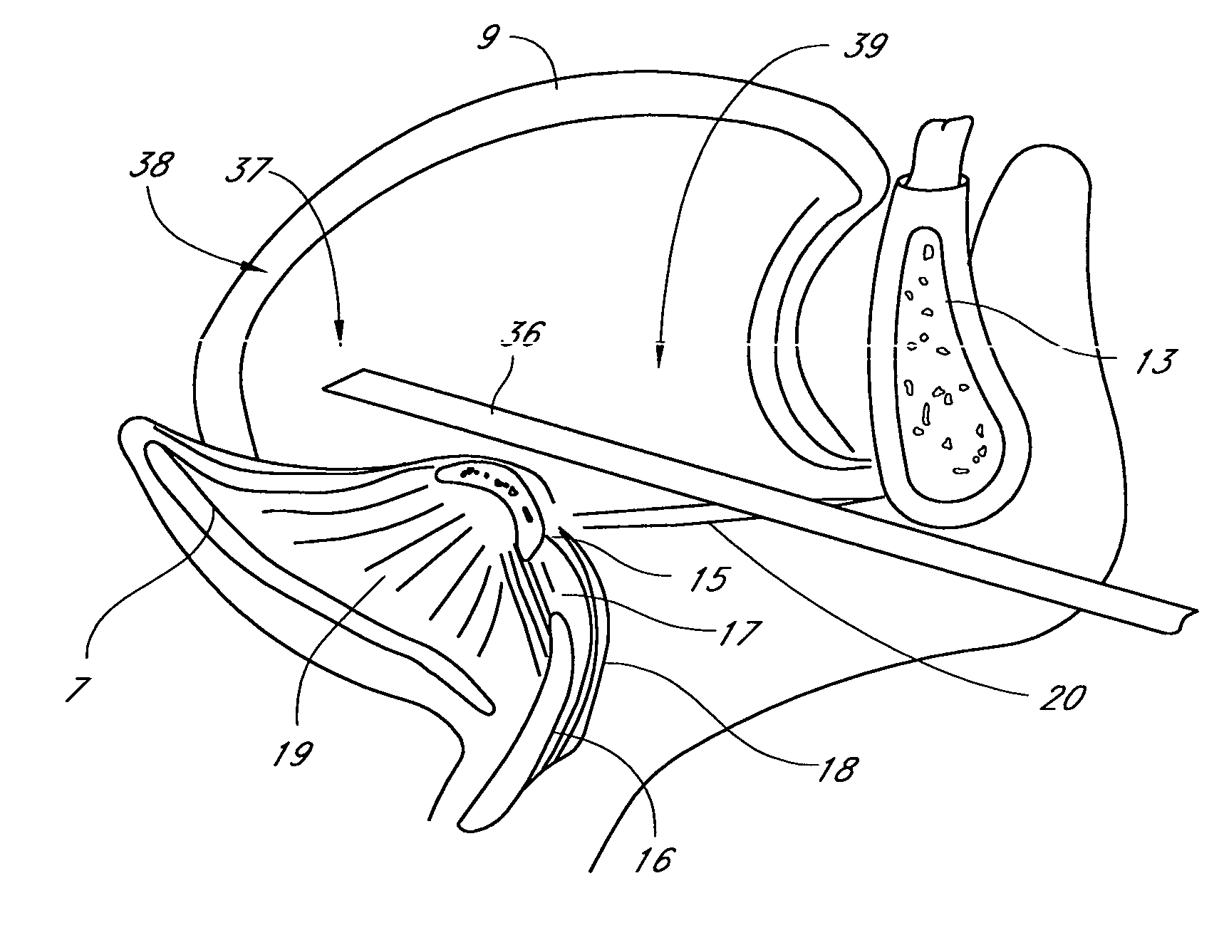 System and method for percutaneous palate remodeling