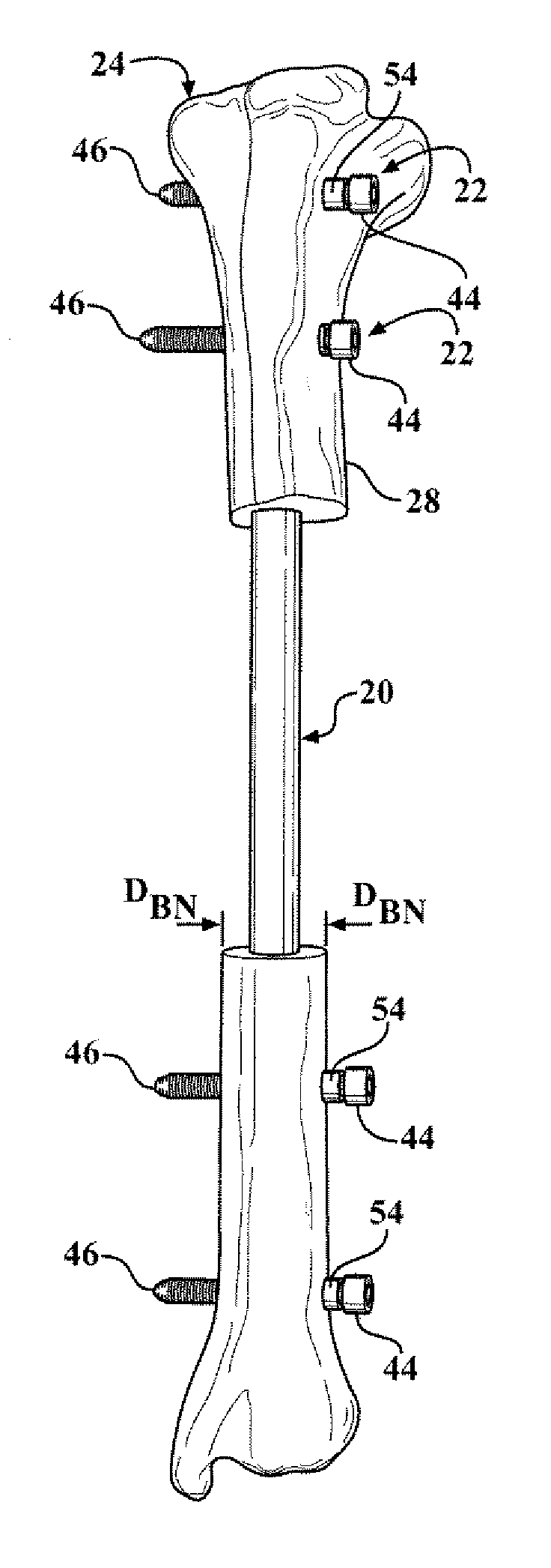 Easily implantable and stable nail-fastener for skeletal fixation and method