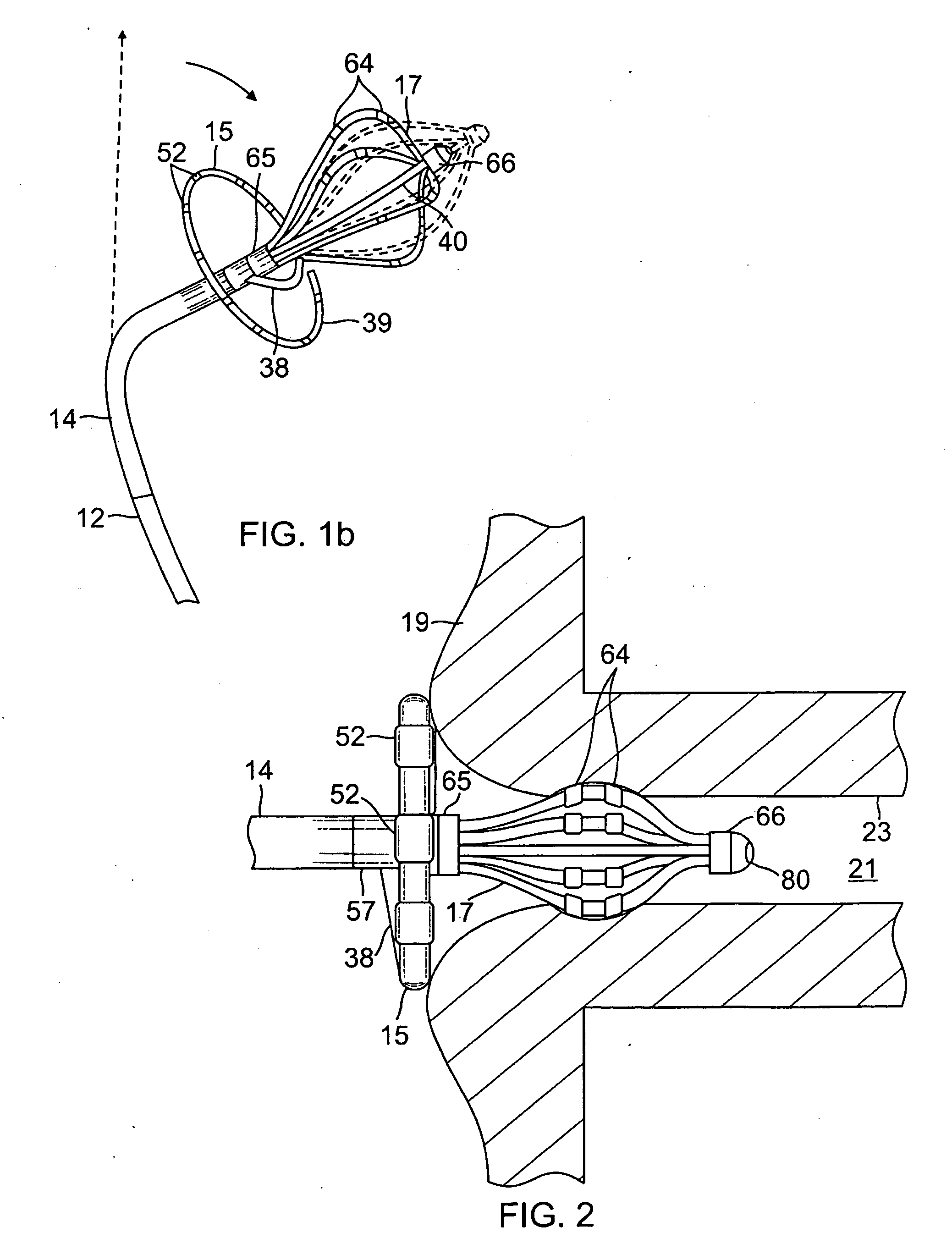 Catheter with multiple electrode assemblies for use at or near tubular regions of the heart