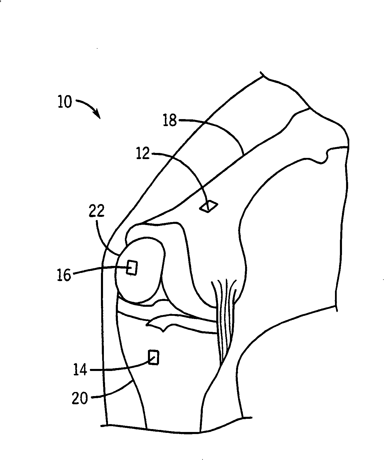 System and method for measurement of clinical parameters of the knee for use during knee replacement surgery