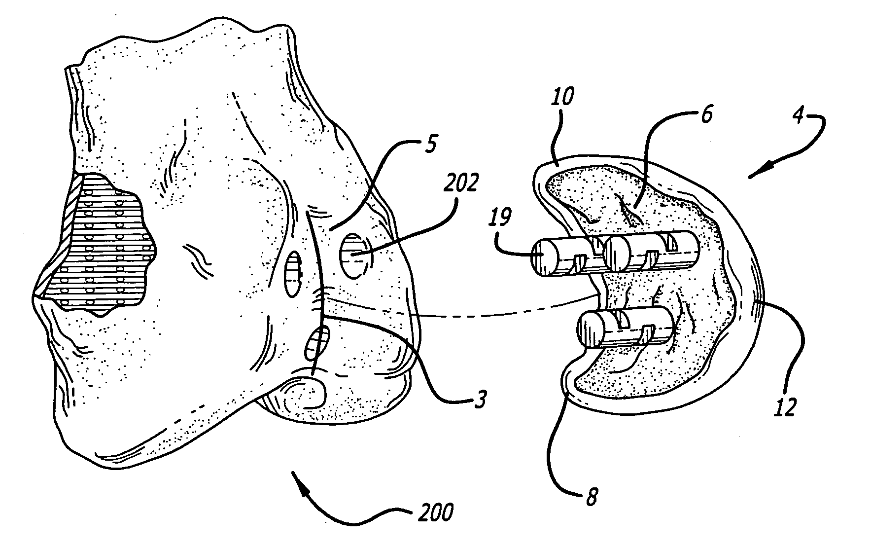 Custom replacement device for resurfacing a femur and method of making the same