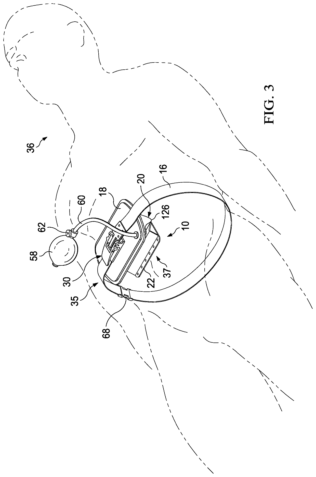 Device to increase intra-abdominal compartment pressure for the controlling of internal hemorrhage