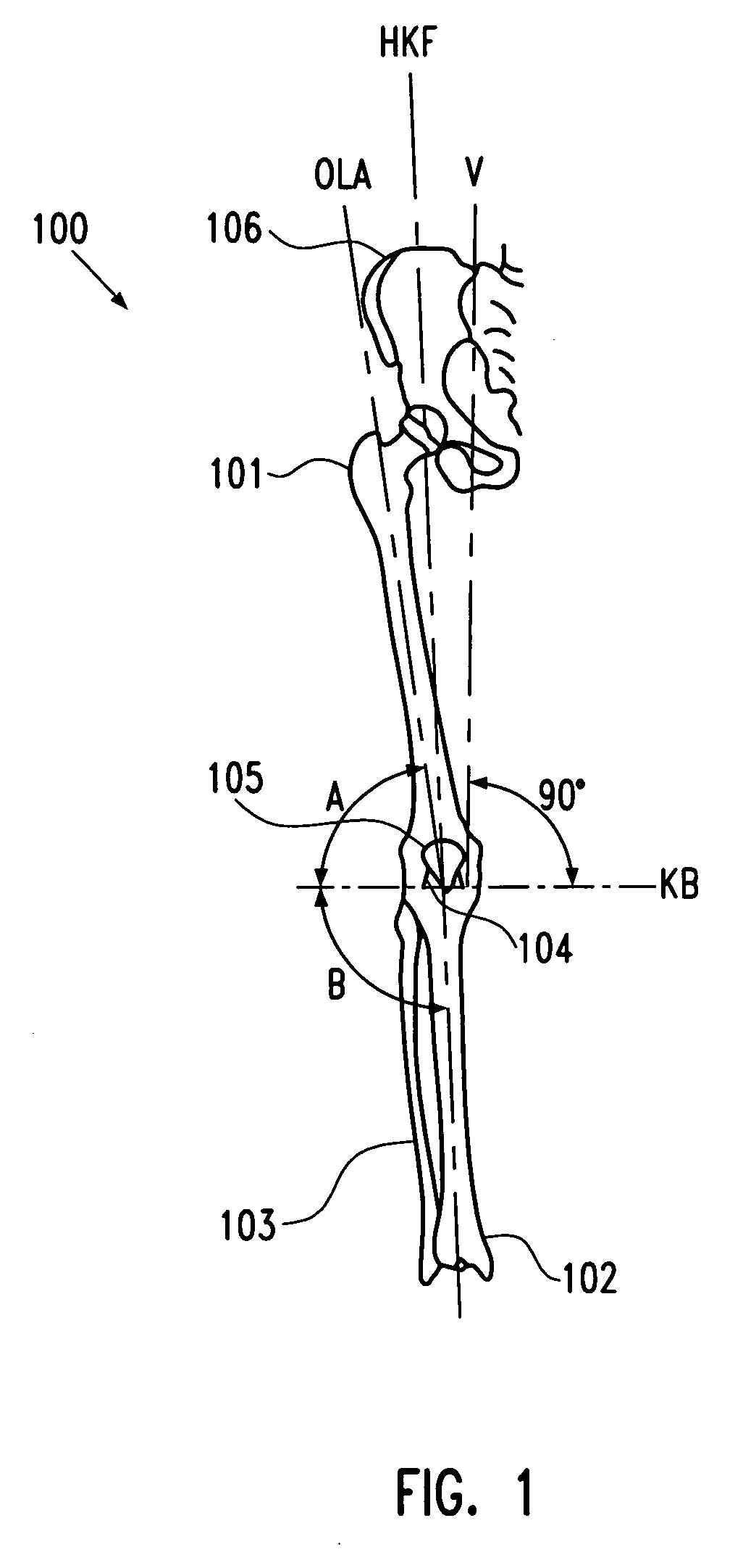 Arthrodesis module and method for providing a patient with an arthrodesis