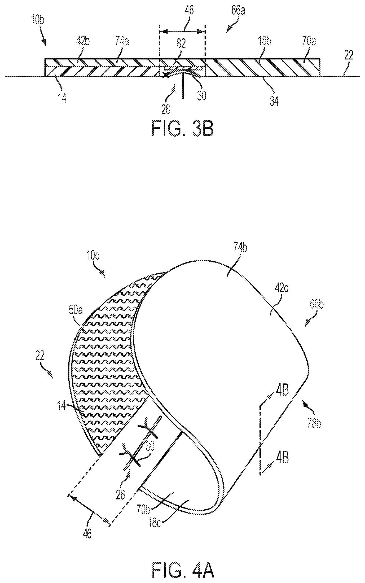 Apparatuses and methods for minimizing wound dehiscense, scar spread, and/or the like