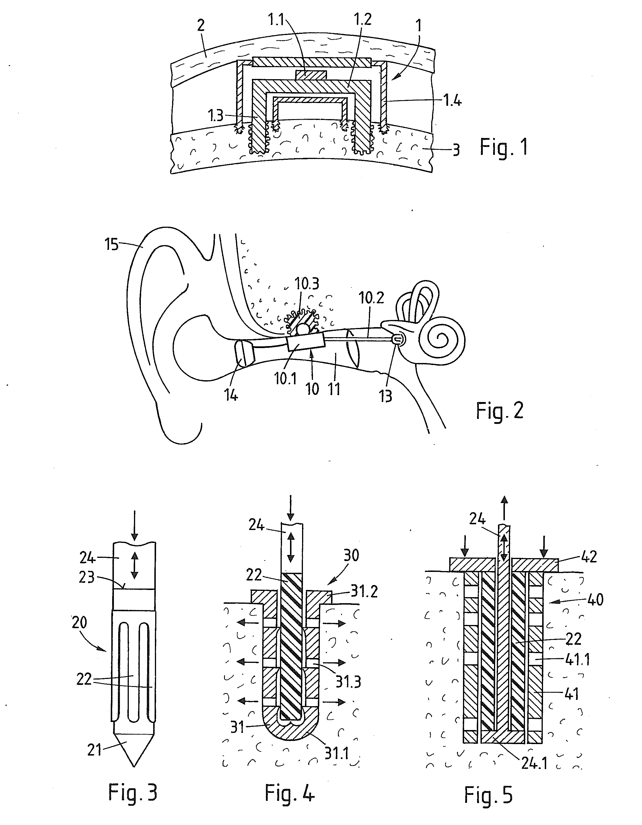 Method of anchoring an acoustic element in a bone of the craniomaxillofacial region and acoustic element