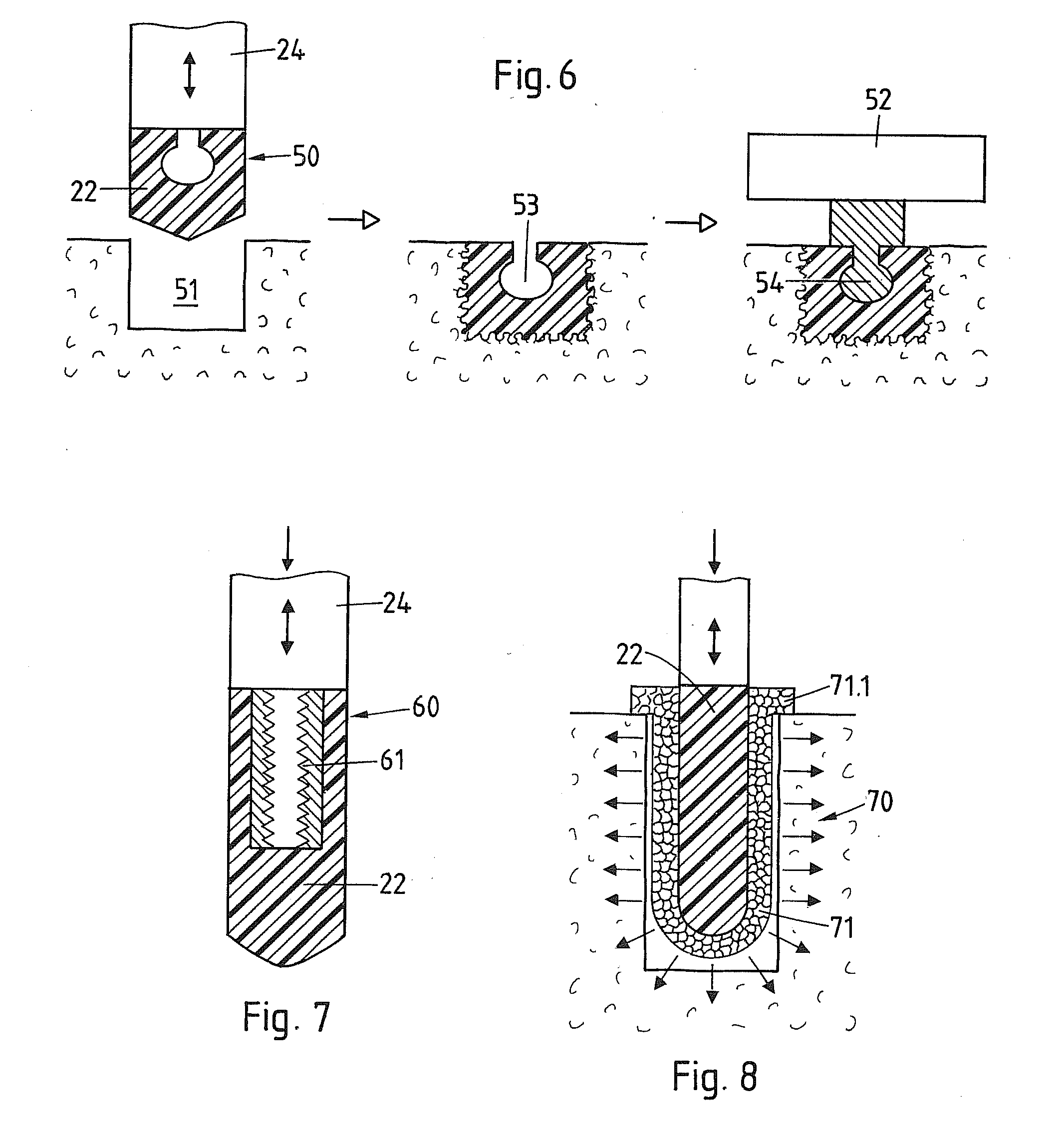 Method of anchoring an acoustic element in a bone of the craniomaxillofacial region and acoustic element
