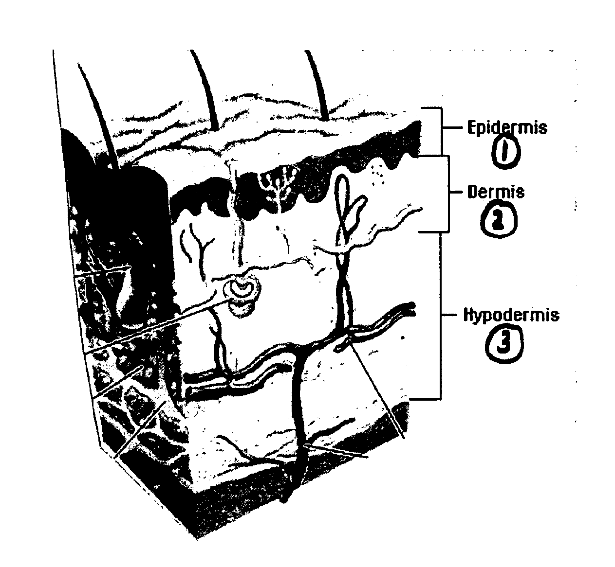 Method for correction of female urinary incontinence and skin reduction