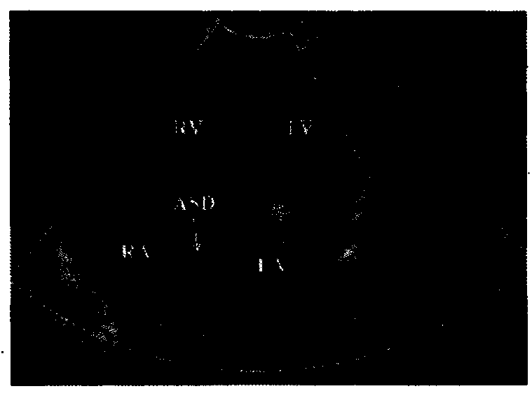 A carbon dioxide microbubble ultrasound contrast agent