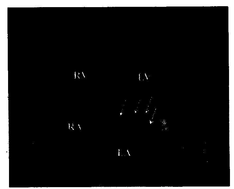 A carbon dioxide microbubble ultrasound contrast agent