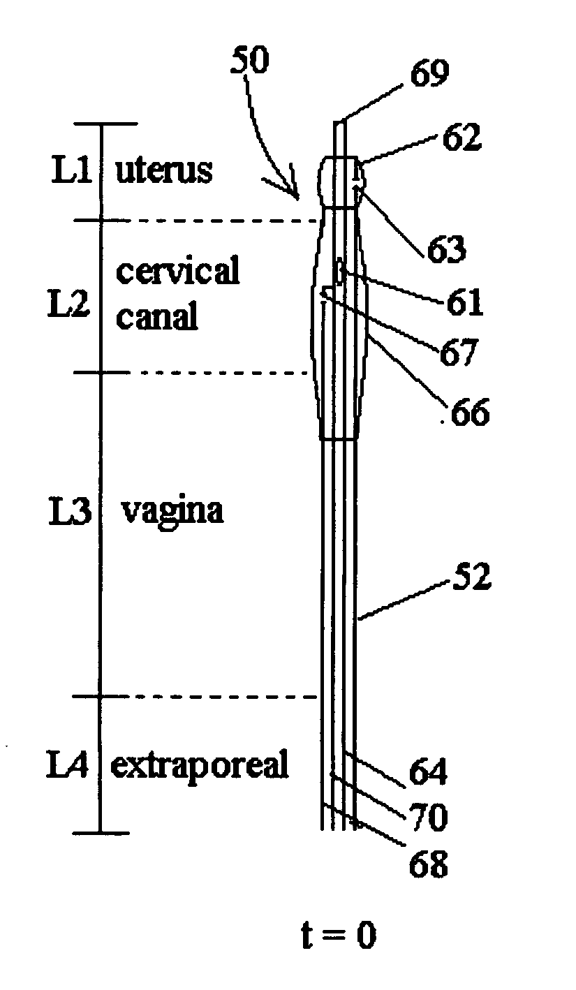 Inflatable system for cervical dilation and labor induction