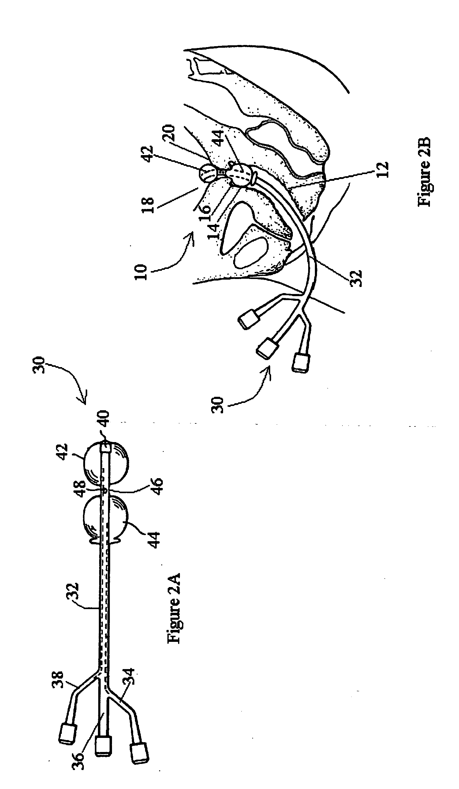 Inflatable system for cervical dilation and labor induction