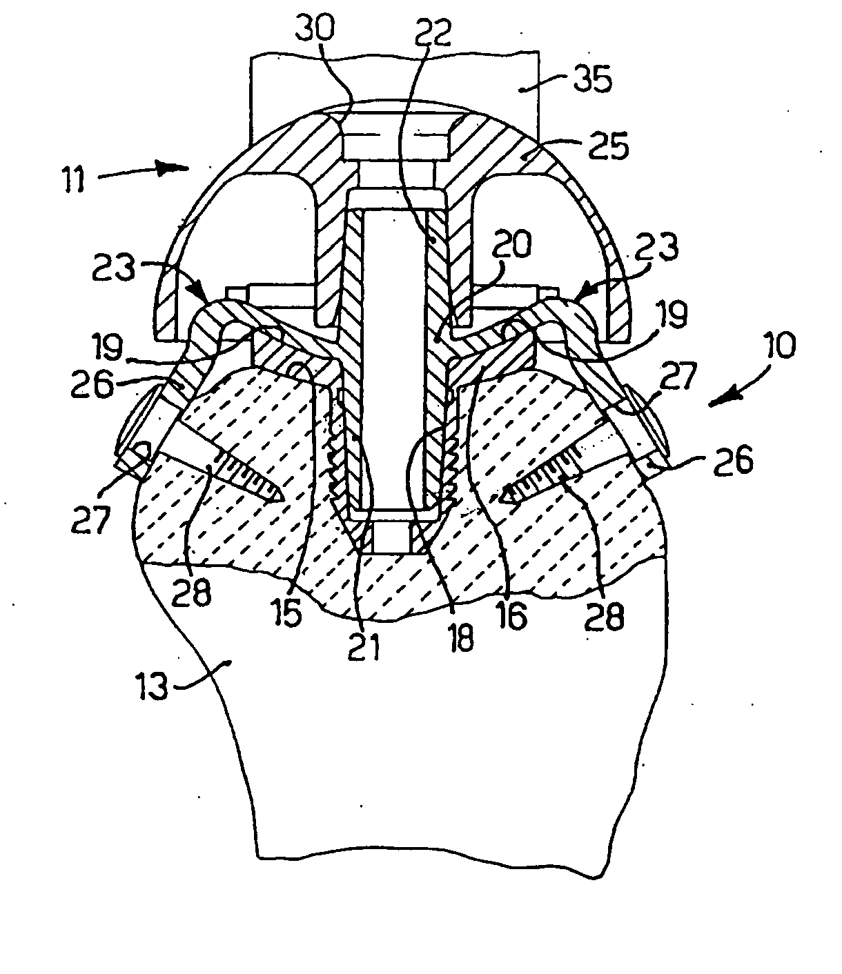 Attachment element for a prosthesis for the articulation of the shoulder