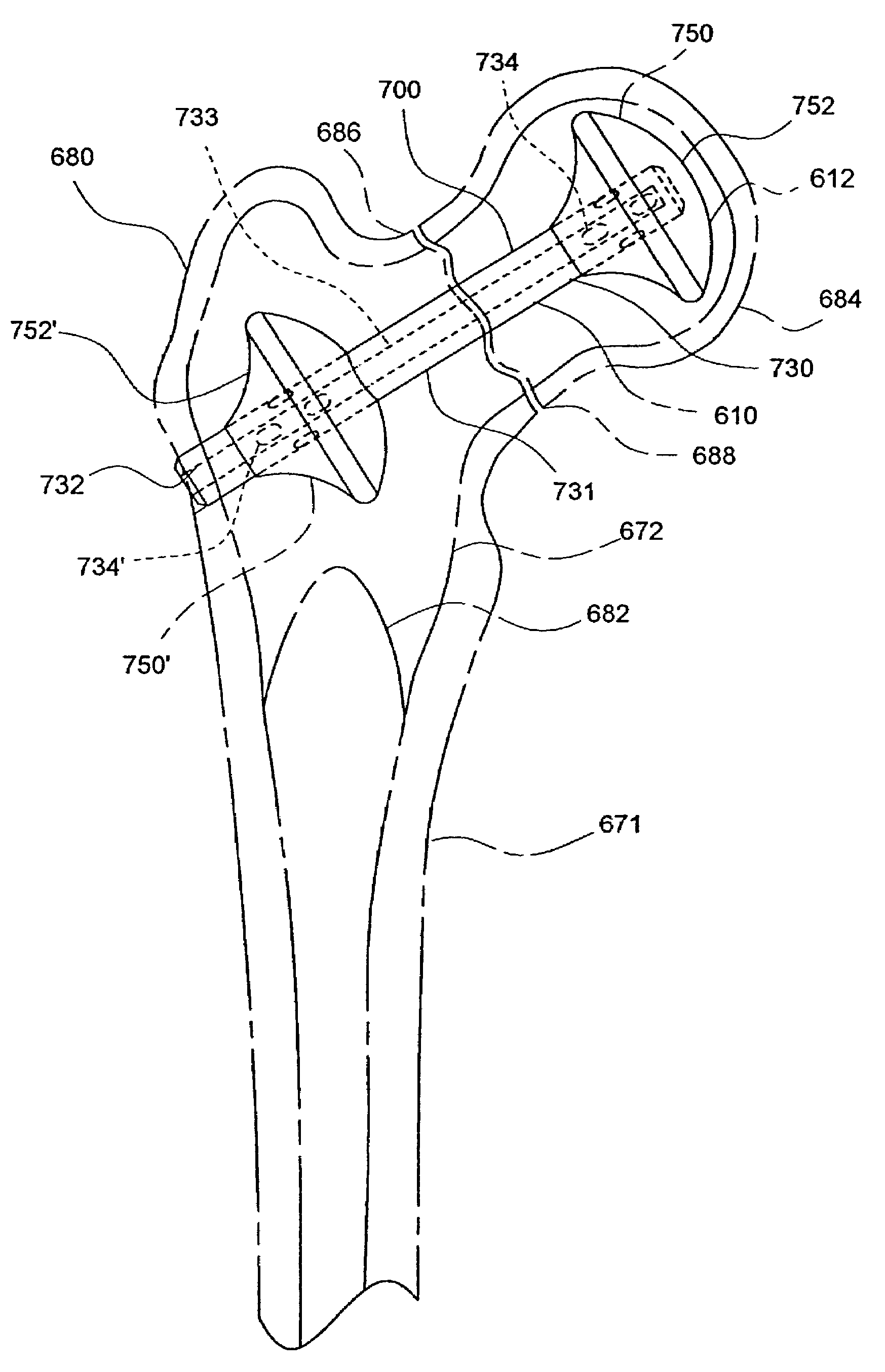 Orthopaedic implant fixation using an in-situ formed anchor