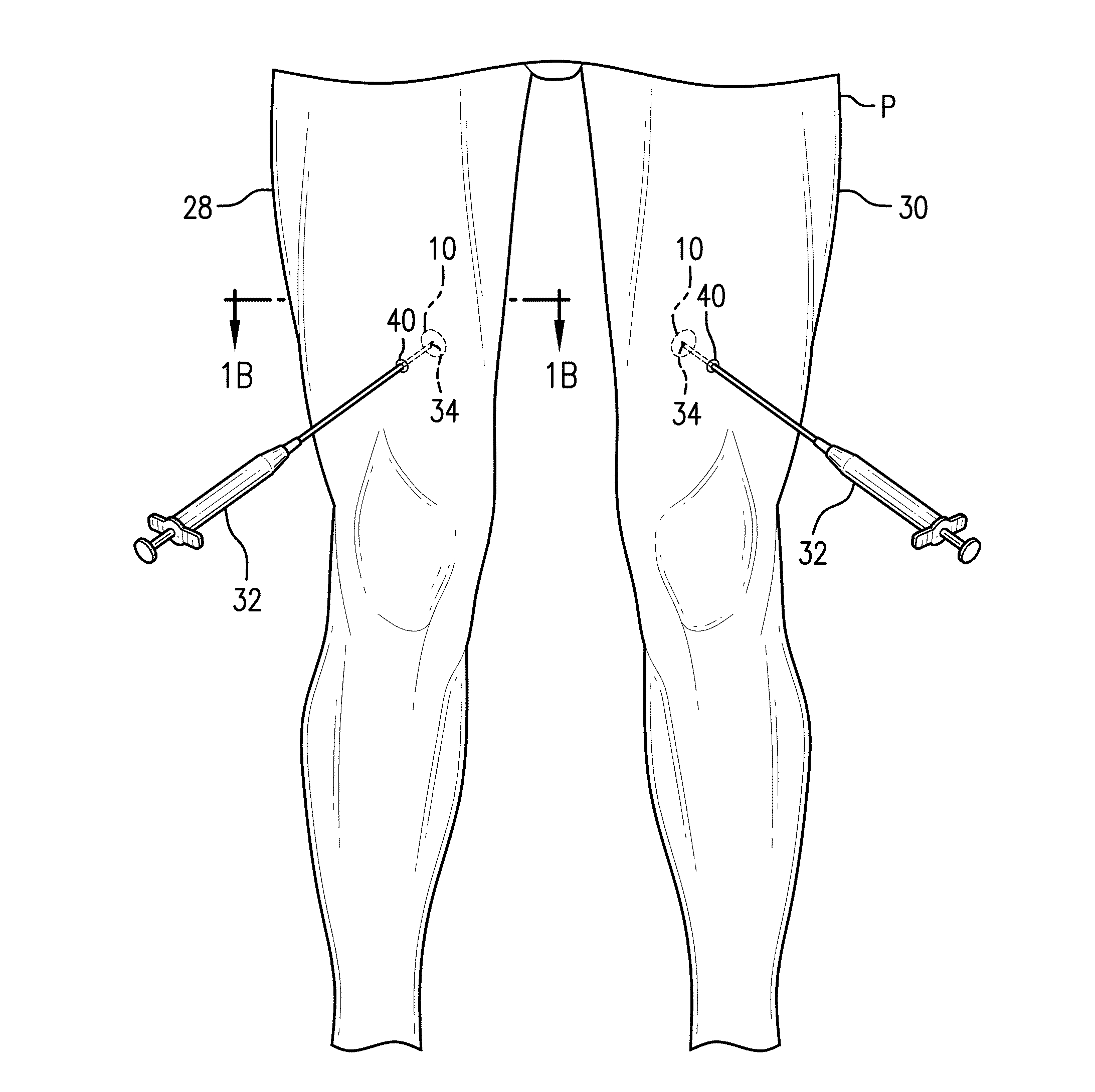 Method for Treating and Confirming Diagnosis of Exertional Compartment Syndrome
