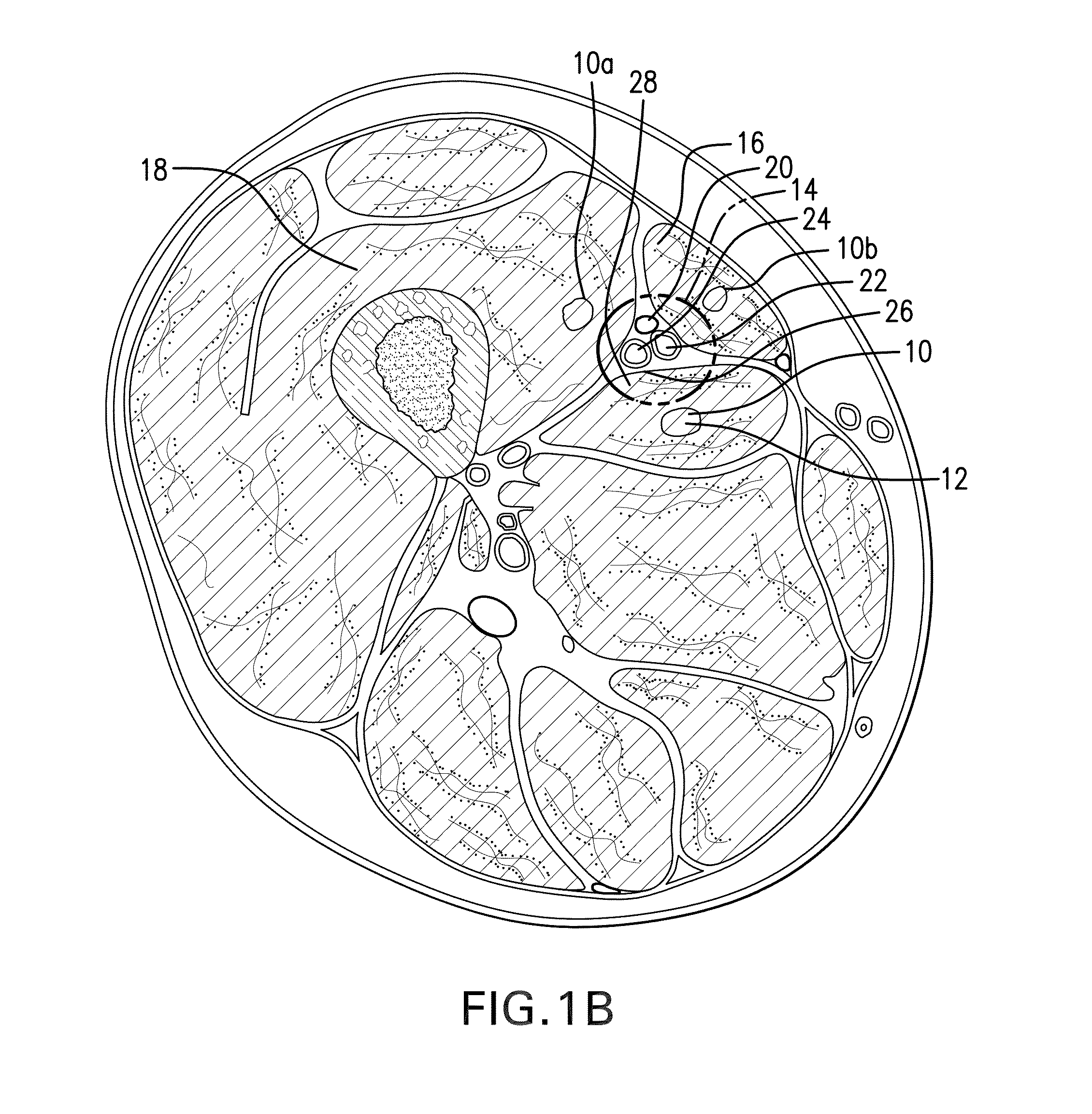 Method for Treating and Confirming Diagnosis of Exertional Compartment Syndrome