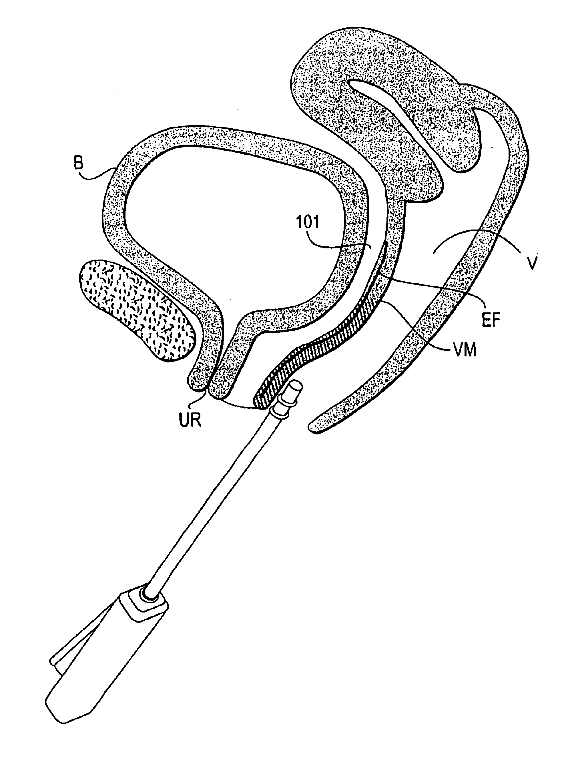 Systems and methods using vasoconstriction for improved thermal treatment of tissues