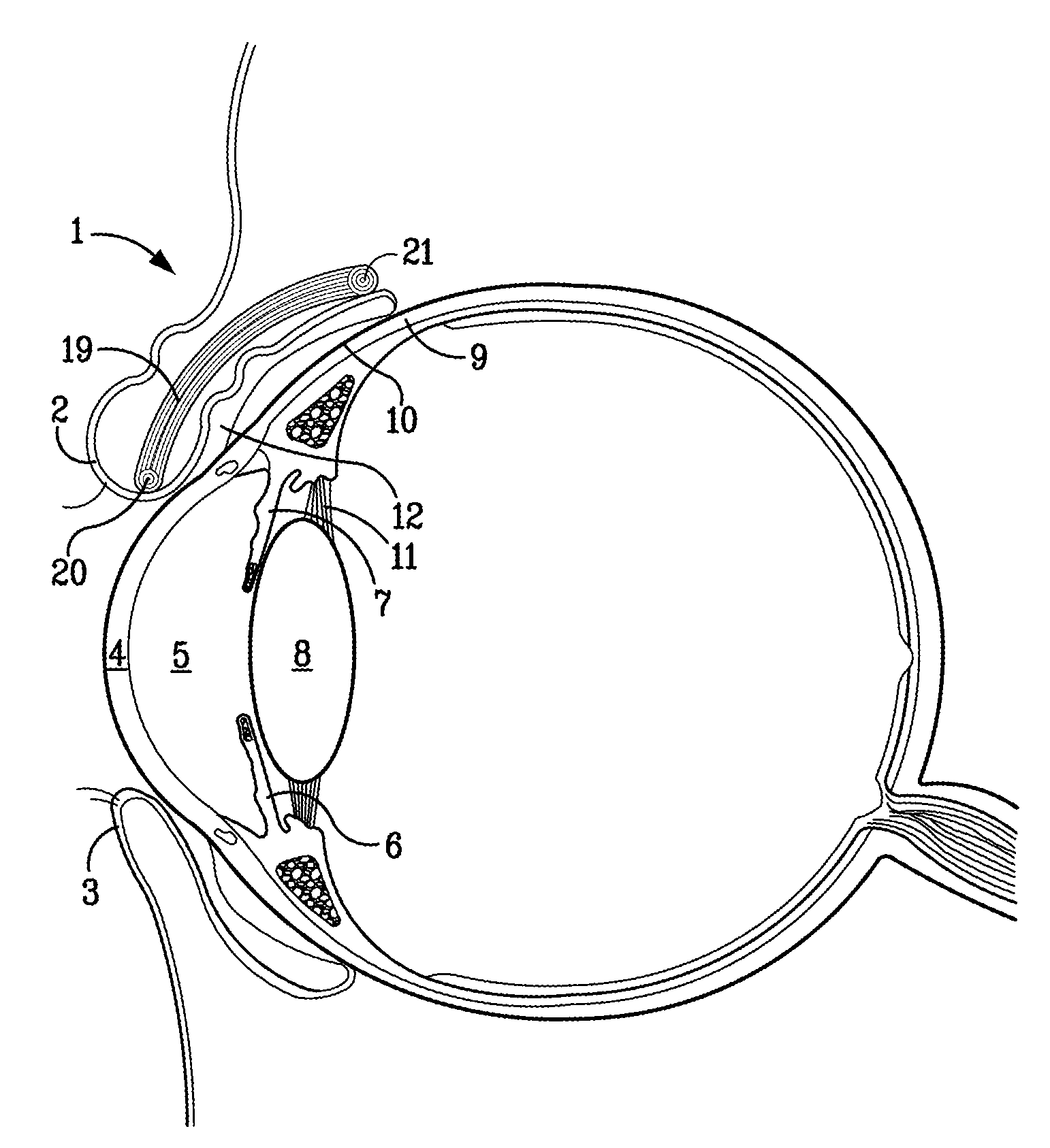 Surgical correction of ptosis by polymeric artificial muscles