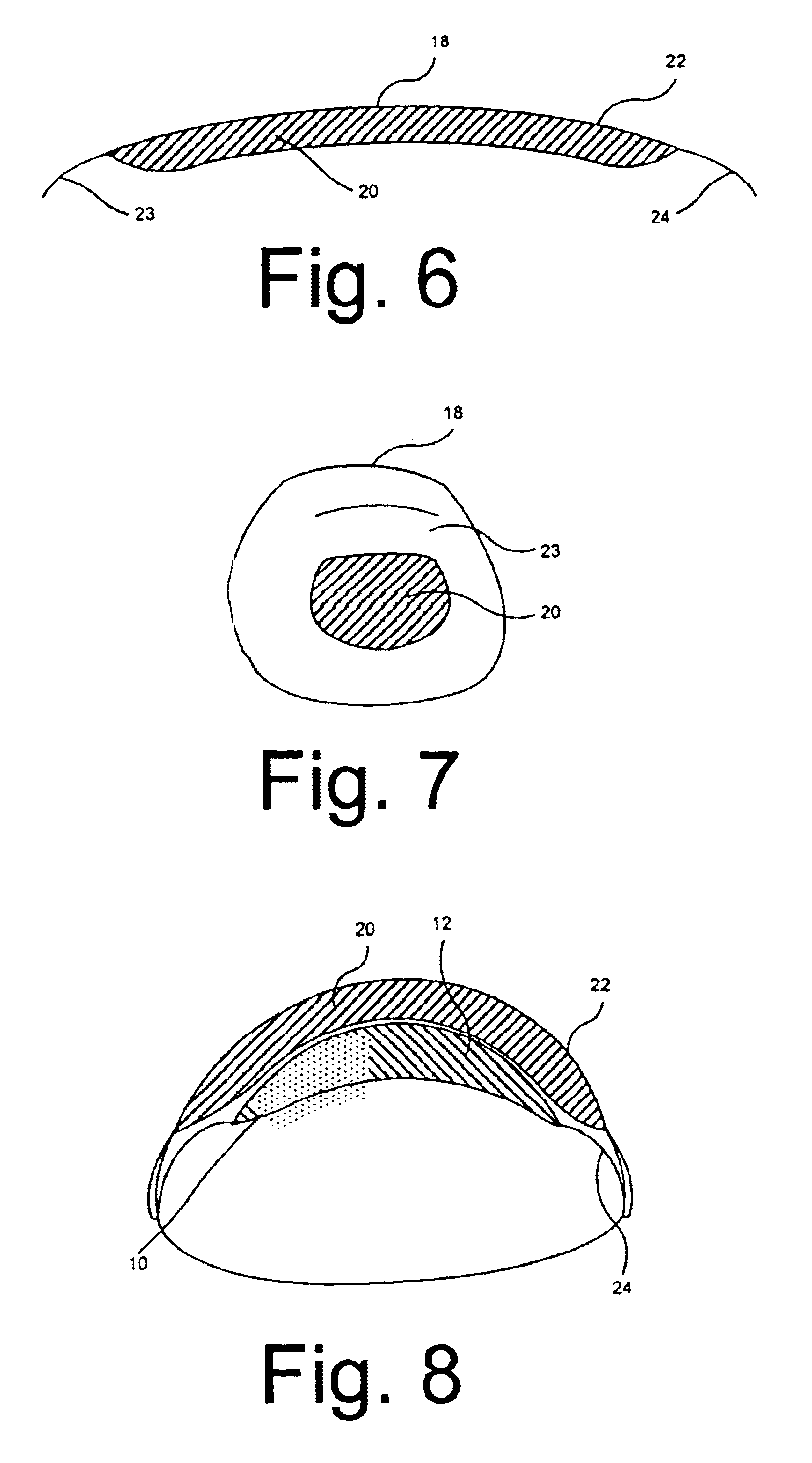 Treatment modality and method for fungal nail infection