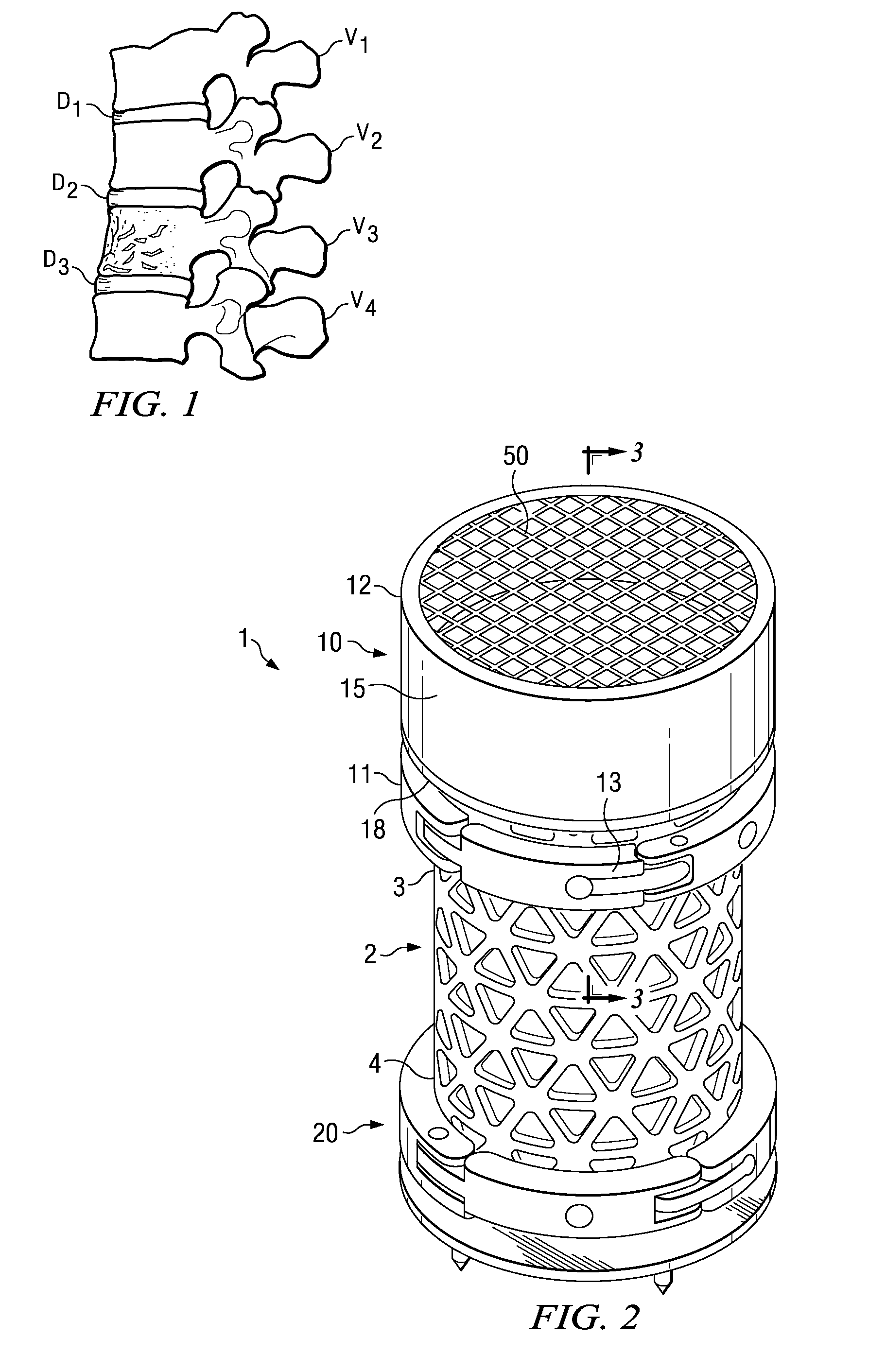 Spinal implant configured to apply radiation treatment and method
