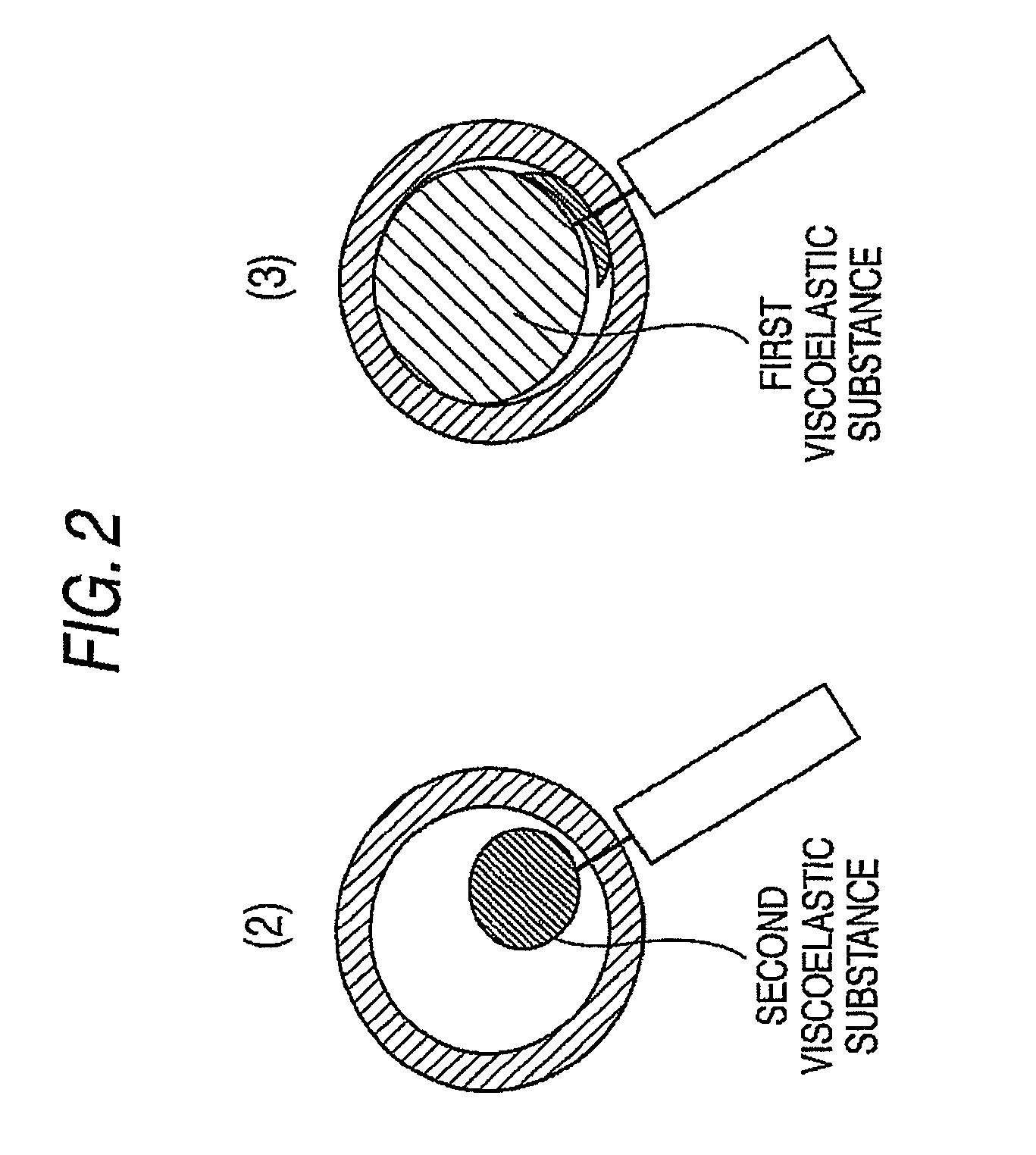 Method of ophthalmic surgery and kit therefor