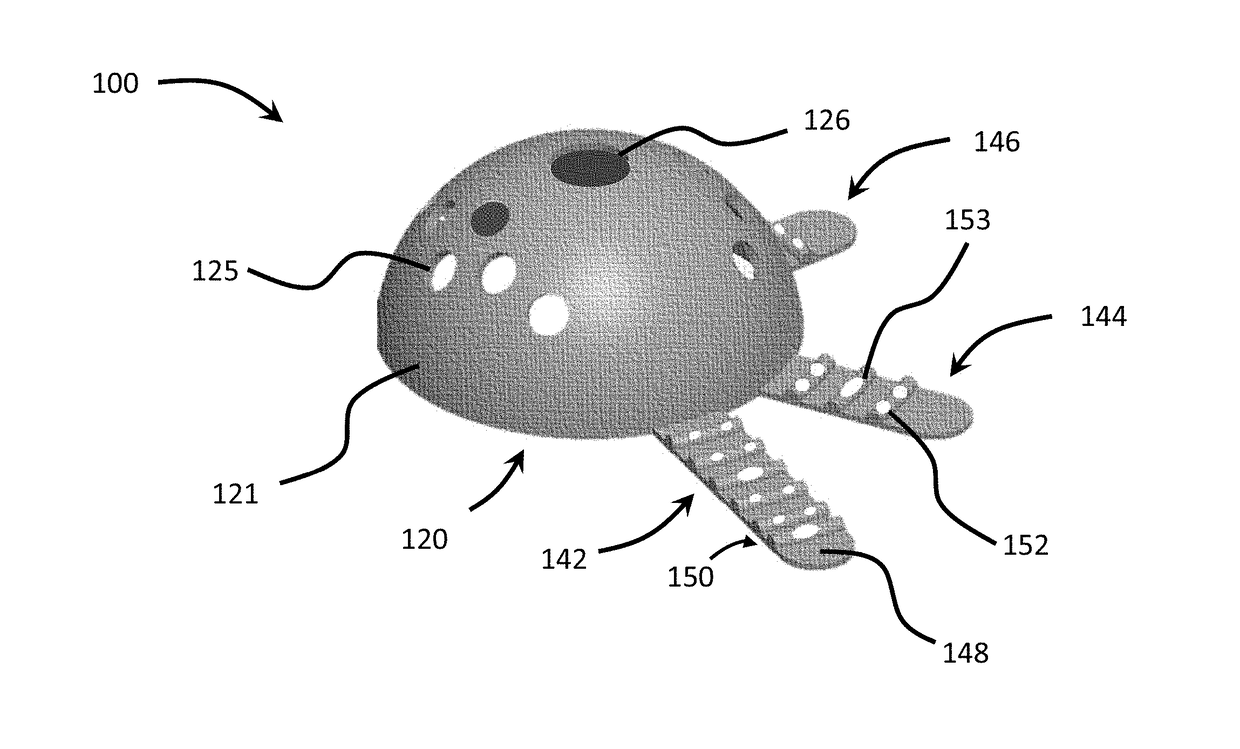 Patient-specific implant flanges with bone side porous ridges