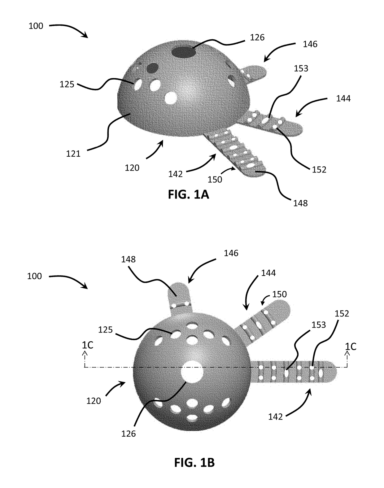 Patient-specific implant flanges with bone side porous ridges