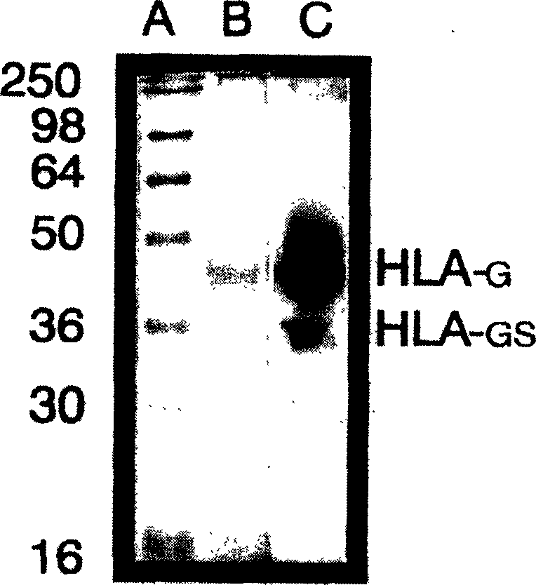 Monoclone antibody for anti HLA-G and hybrid tumour cell secreting same, cancer dignosis method, diagnosis reagent box and its application