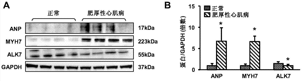 Function and application of activin receptor-like kinase7 (ALK7) in treatment of cardiac hypertrophy