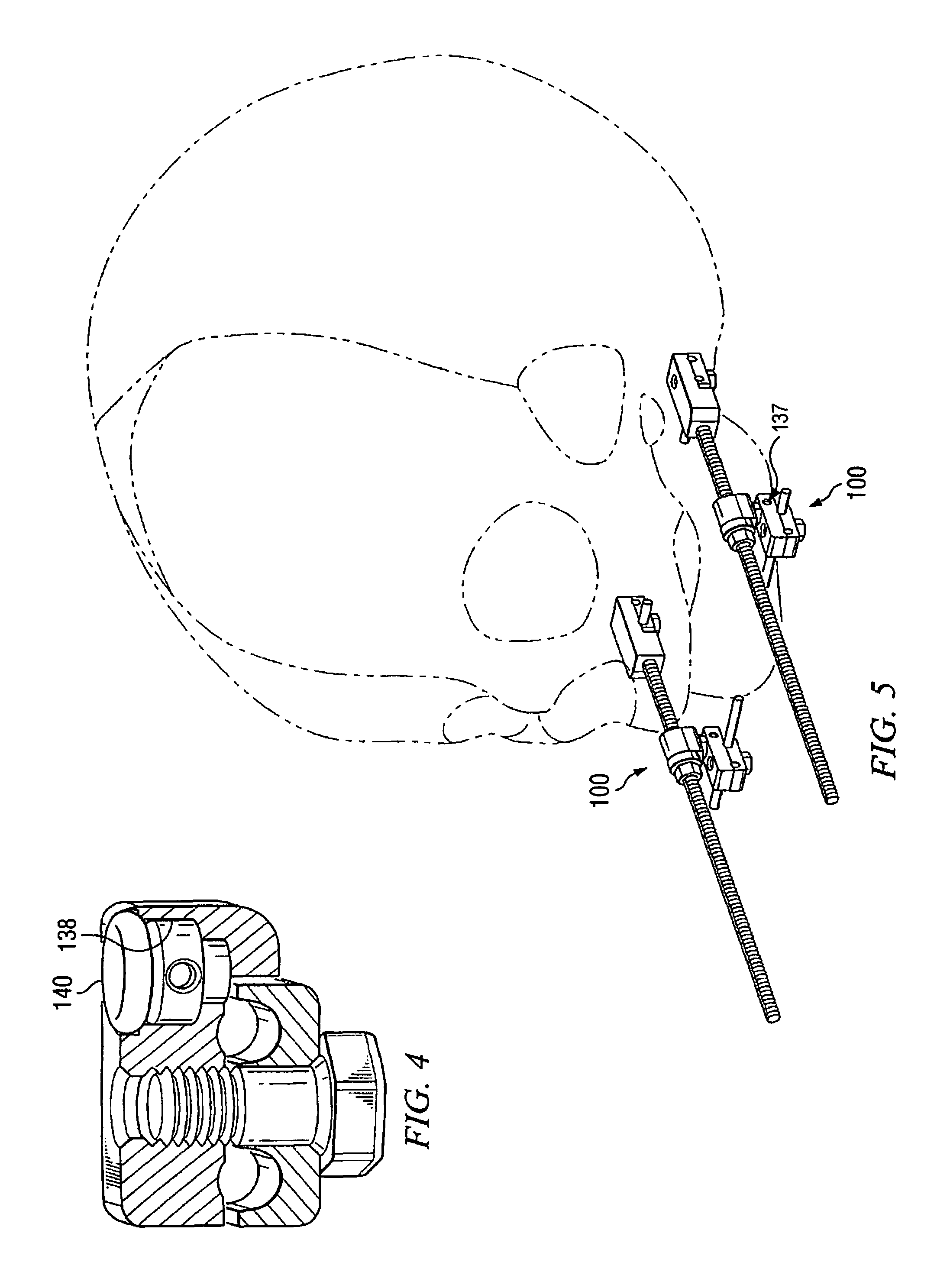 External mandibular distractor with rotational clamp