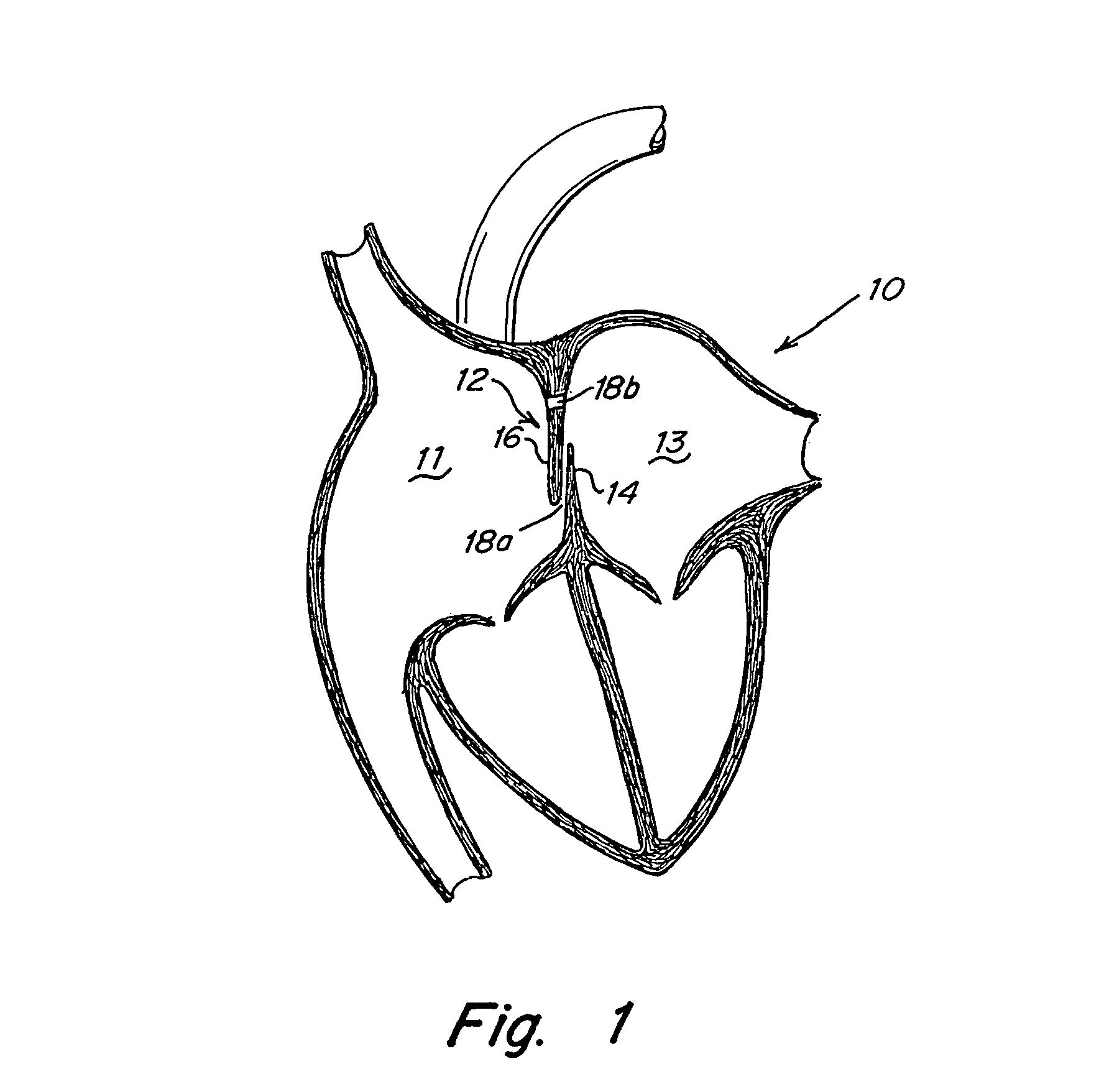Tubular patent foramen ovale (PFO) closure device with catch system