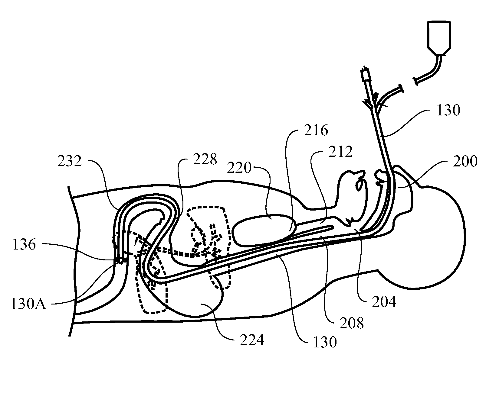 Optically guided feeding tube, catheters and associated methods