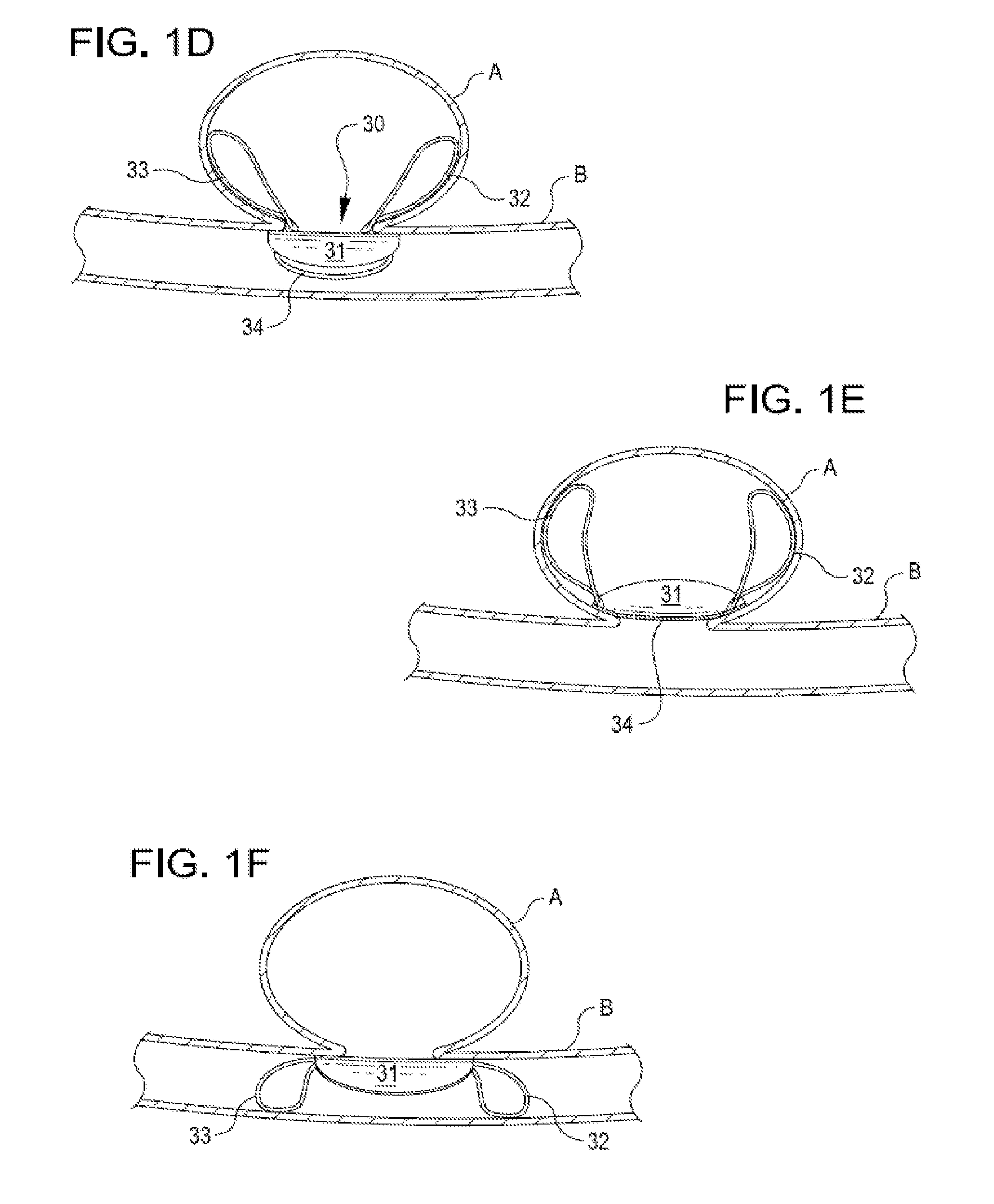 Methods and systems for endovascularly clipping and repairing lumen and tissue defects