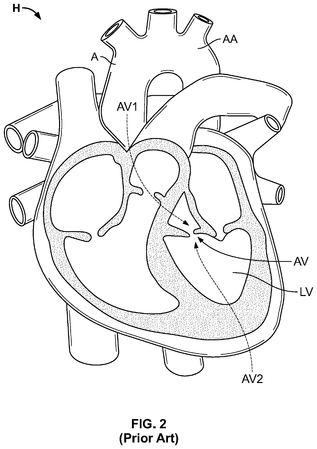 Fully Deployable And Recapturable Prosthetic Heart Valve