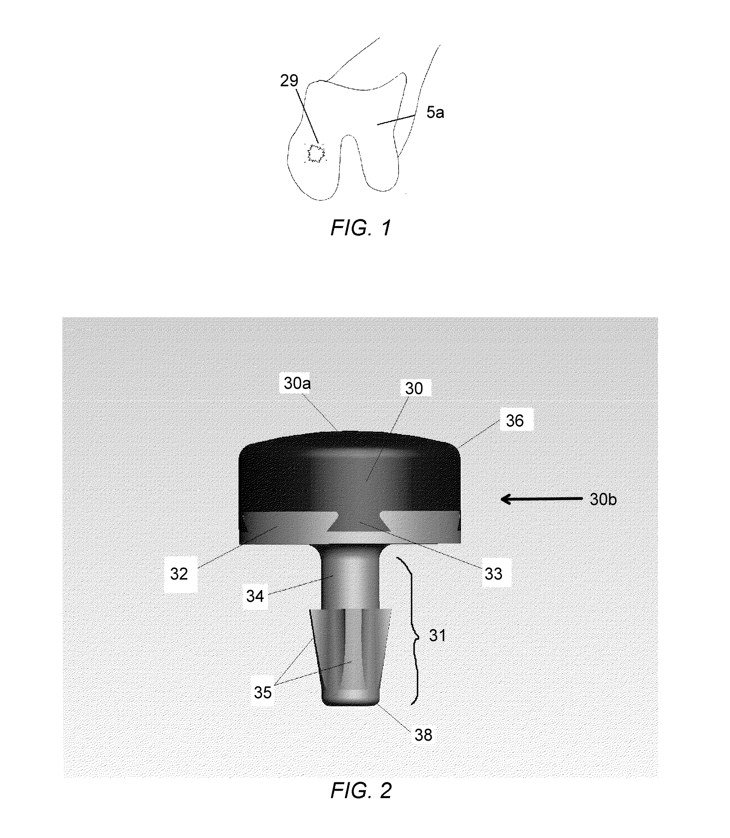 Partial joint resurfacing implant, instrumentation, and method
