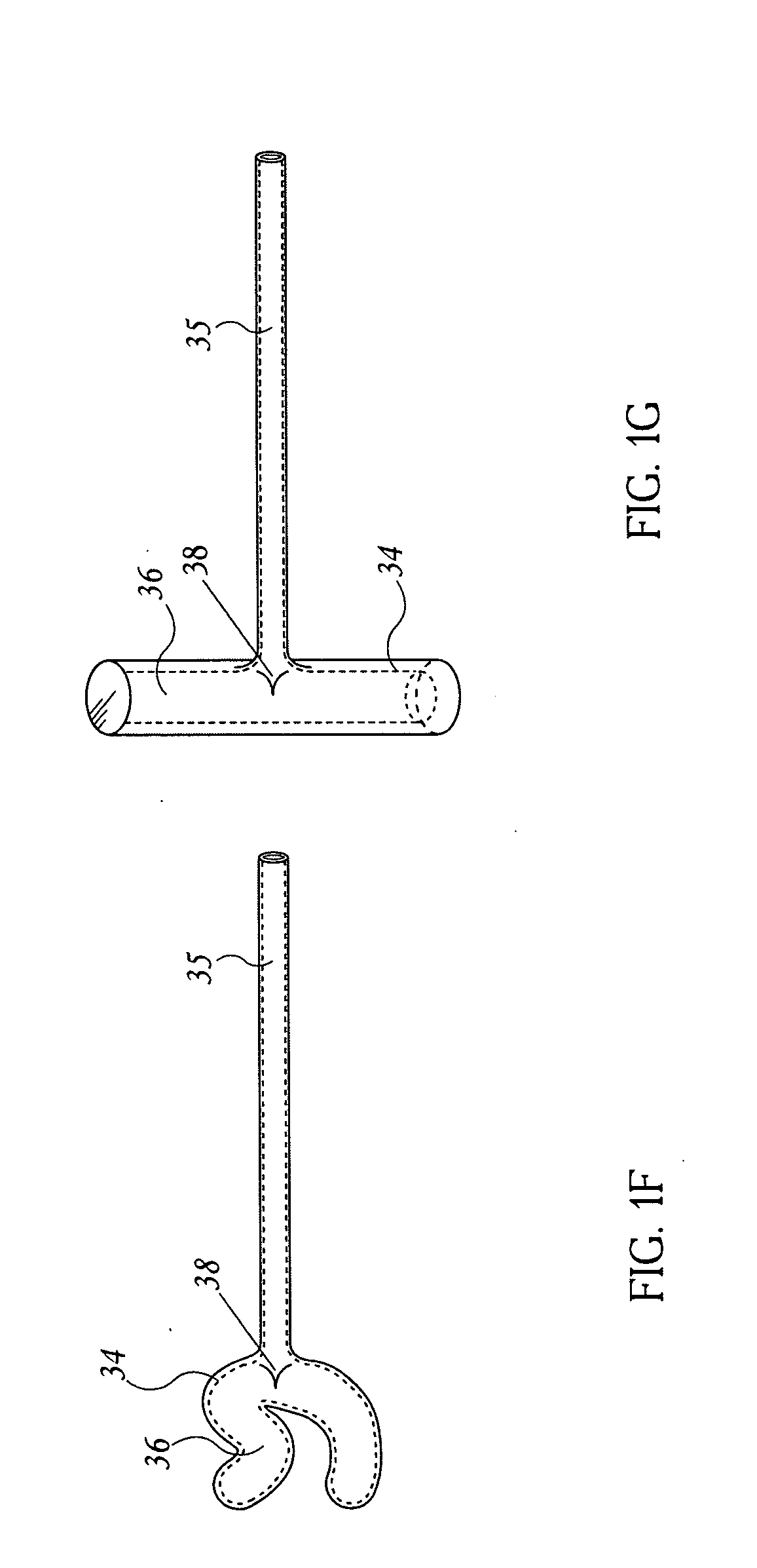 Methods and devices for percutaneous, non-laparoscopic treatment of obesity