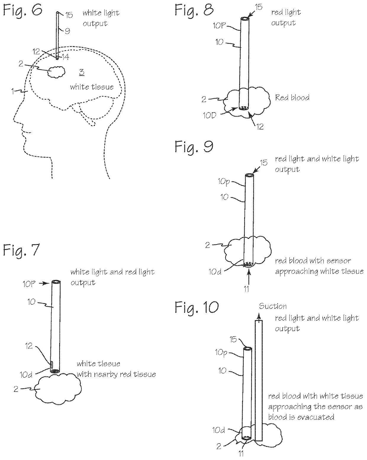 Methods and devices for color detection to localize the blood mass of an intracerebral hematoma