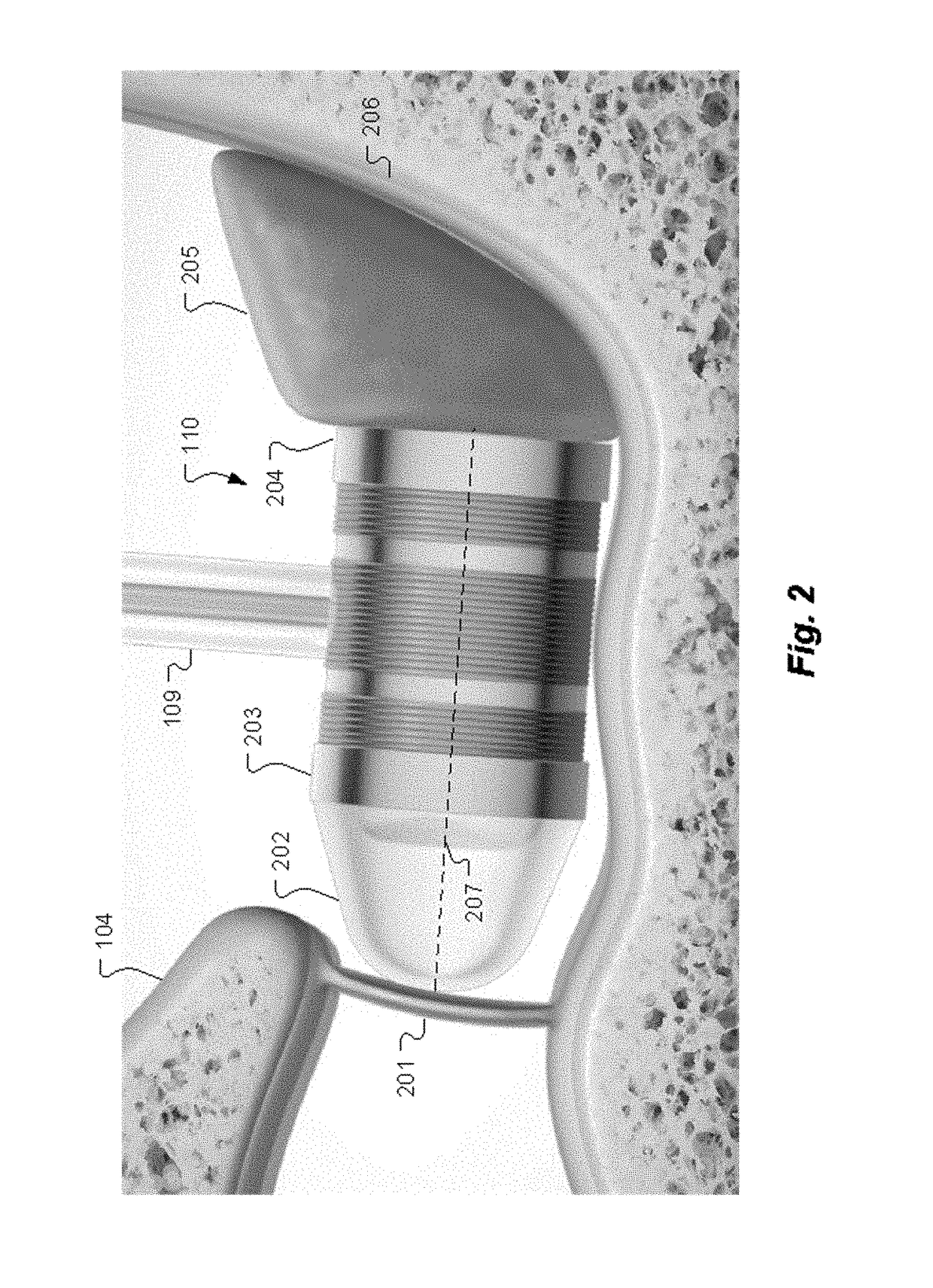 Pre-Load Feedback of a Middle-Ear Coupler