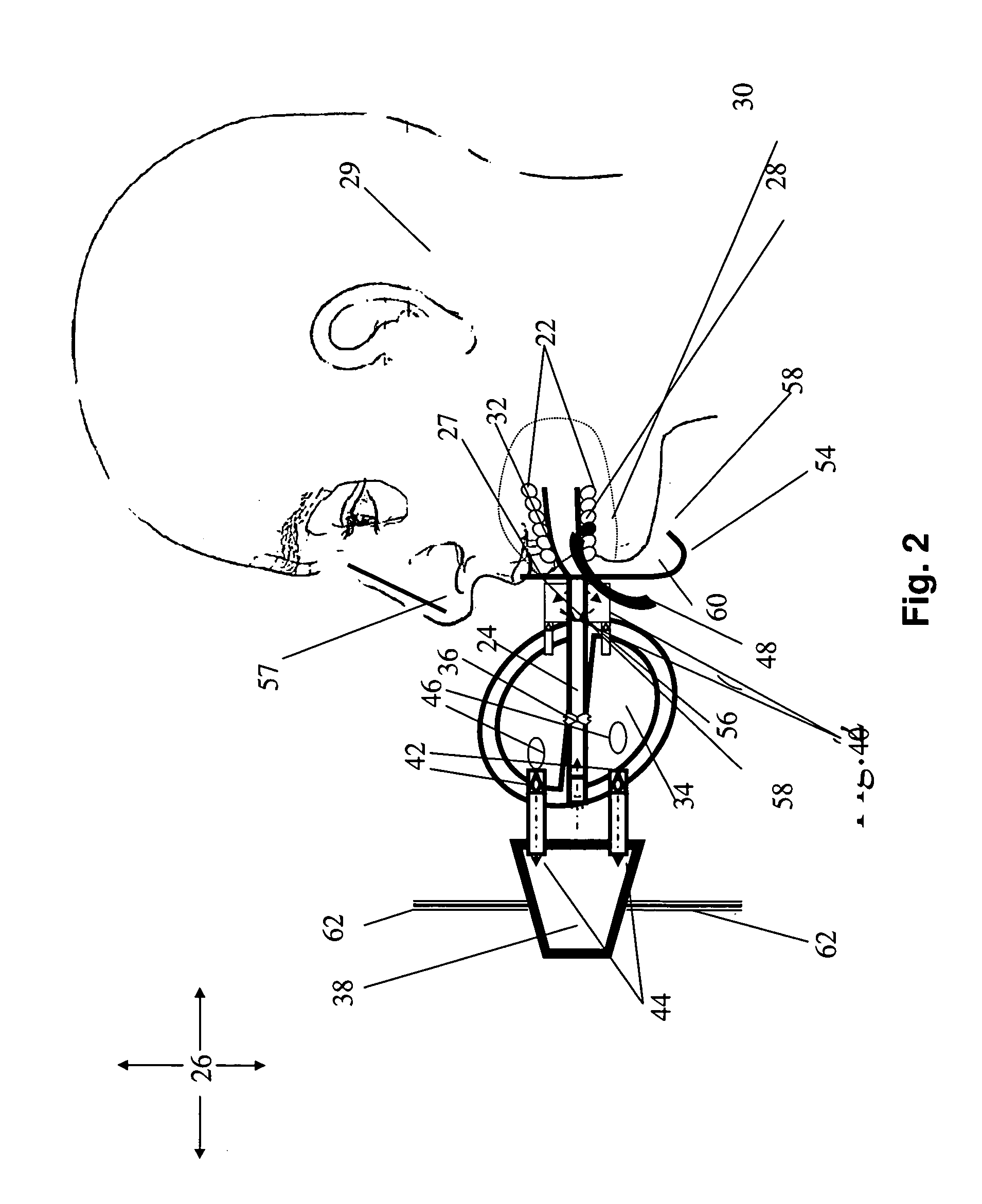 Devices, for preventing collapse of the upper airway, methods for use thereof and systems and articles of manufacture including same