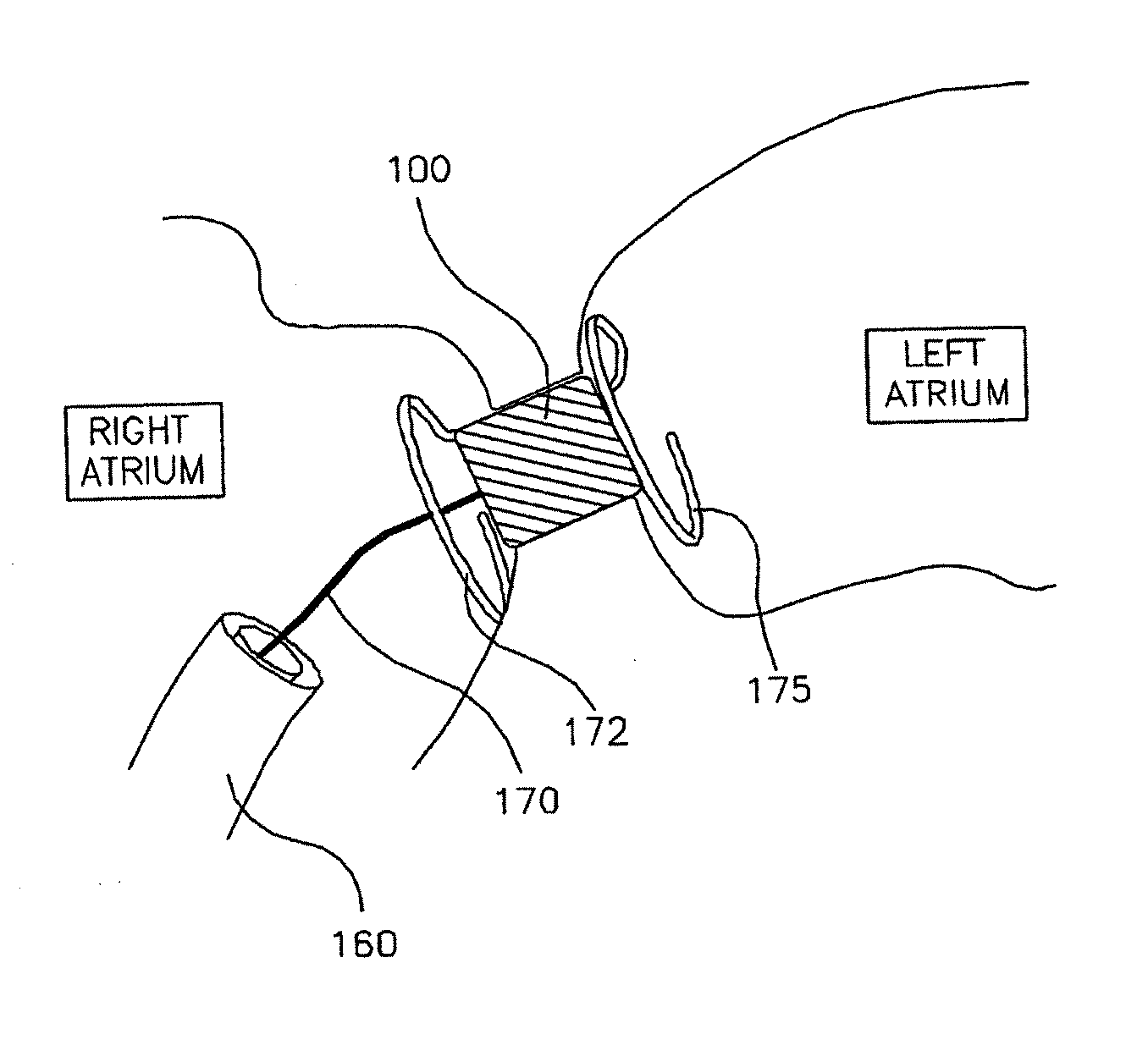 Methods and apparatus for reducing localized circulatory system pressure