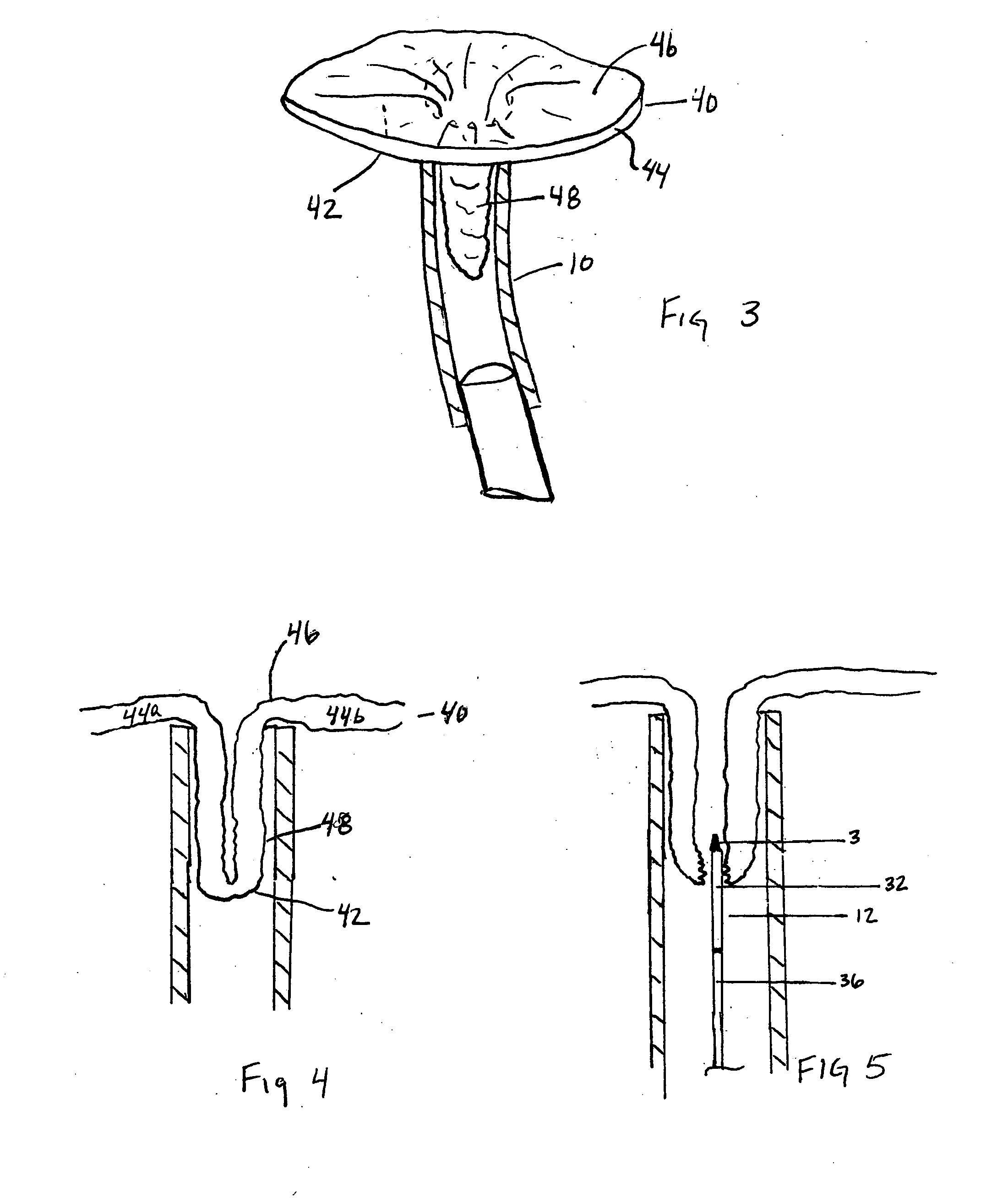 Methods and apparatus for securing an anchor to soft tissue