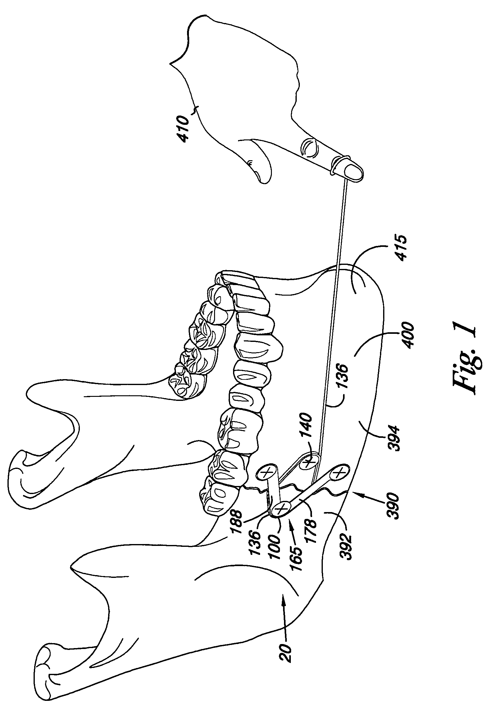 Apparatus and methods for bone fracture reduction and fixation