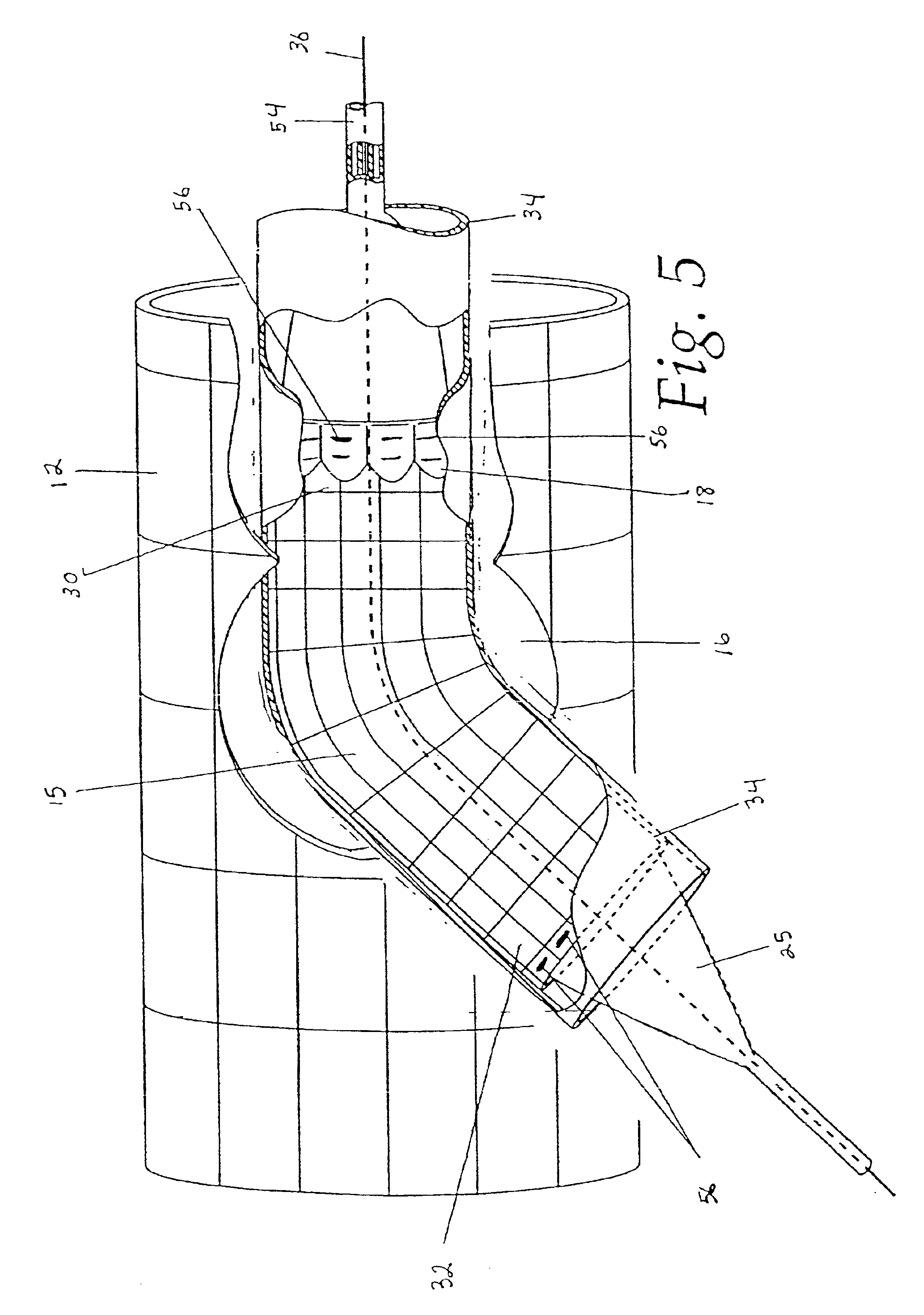 Method for employing an extendible stent apparatus