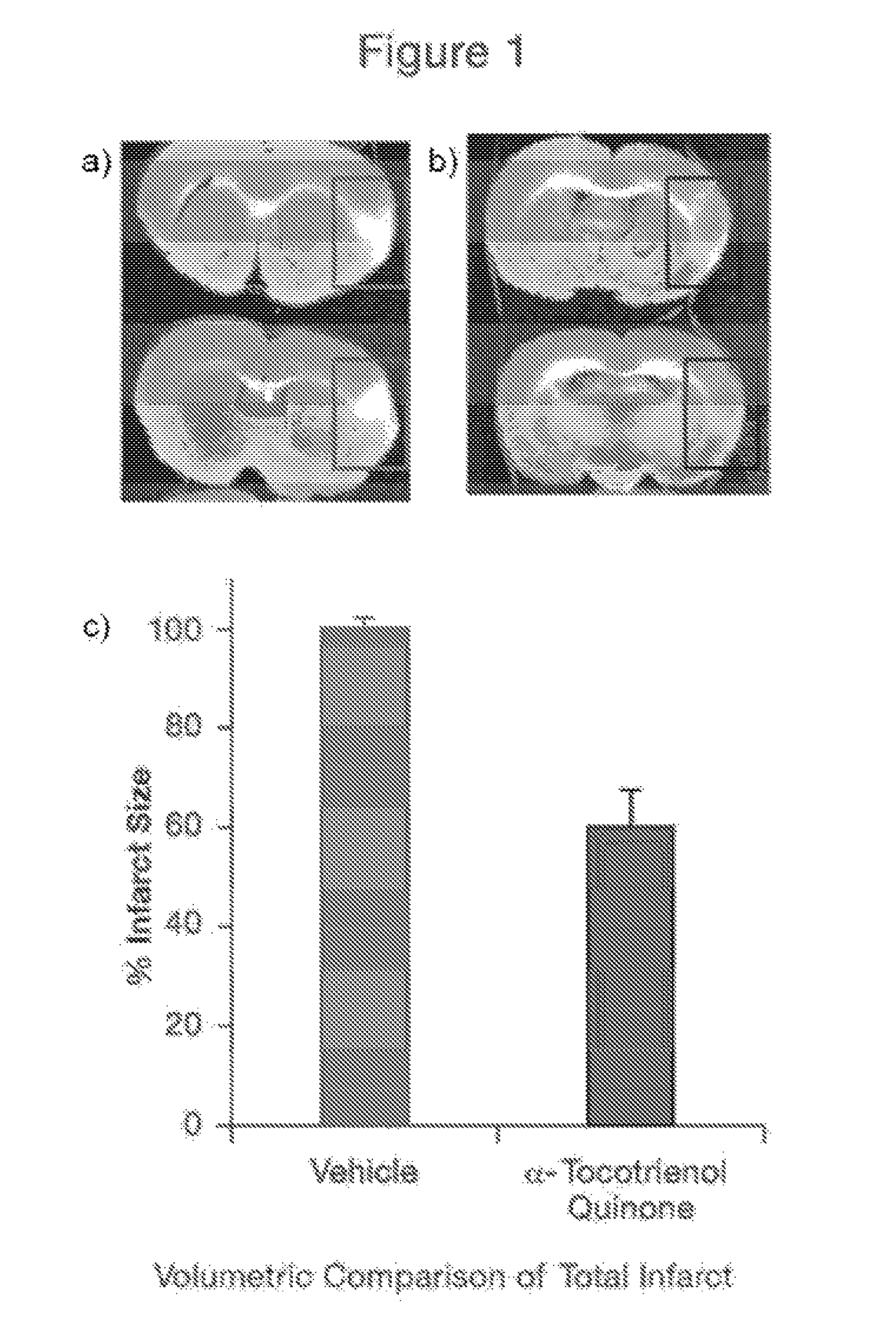 Methods for the prevention and treatment of cerebral ischemia