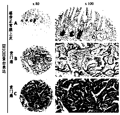 A prognostic marker for cardiac cancer and its application