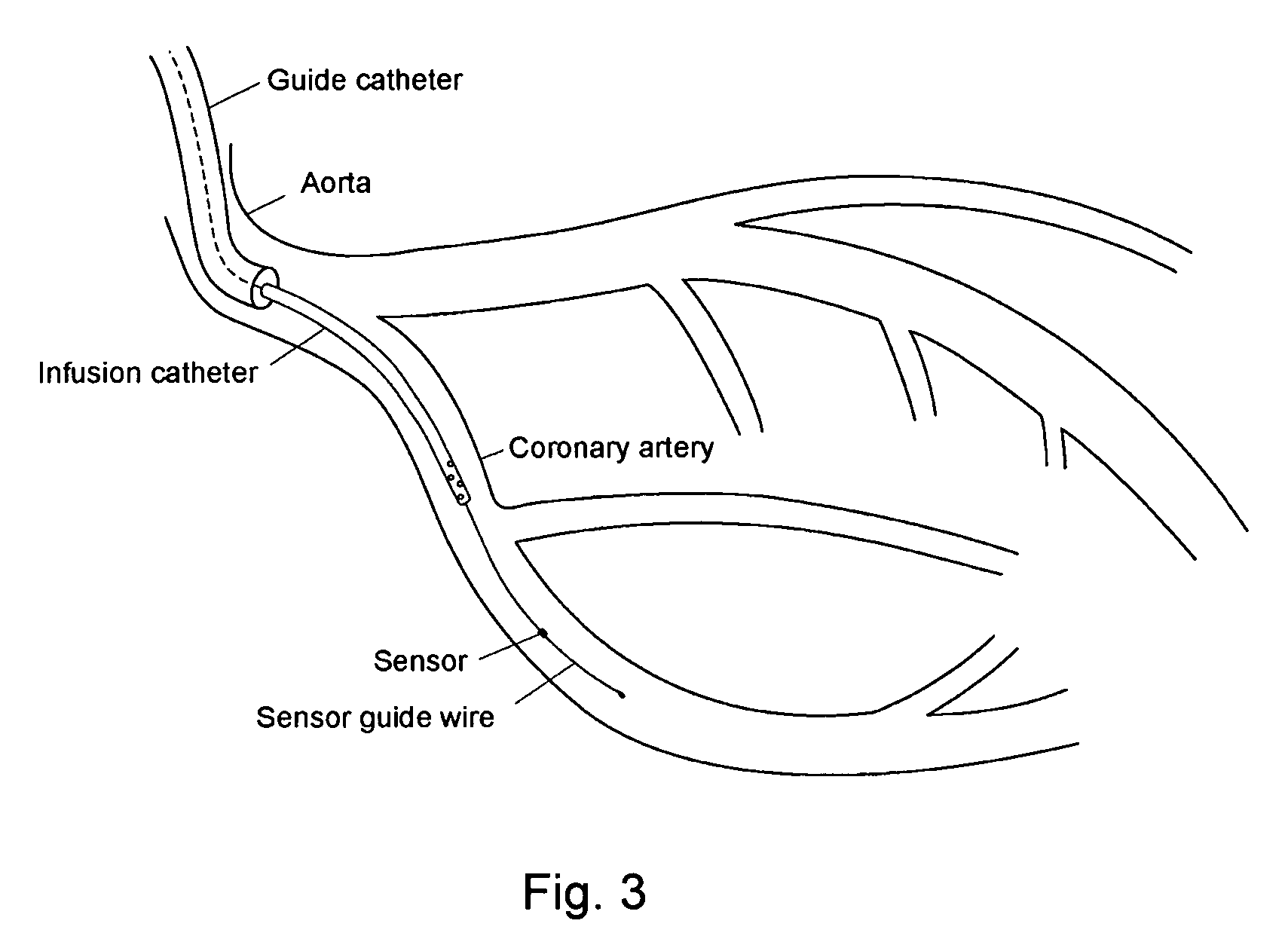Method for determining the blood flow in a coronary artery