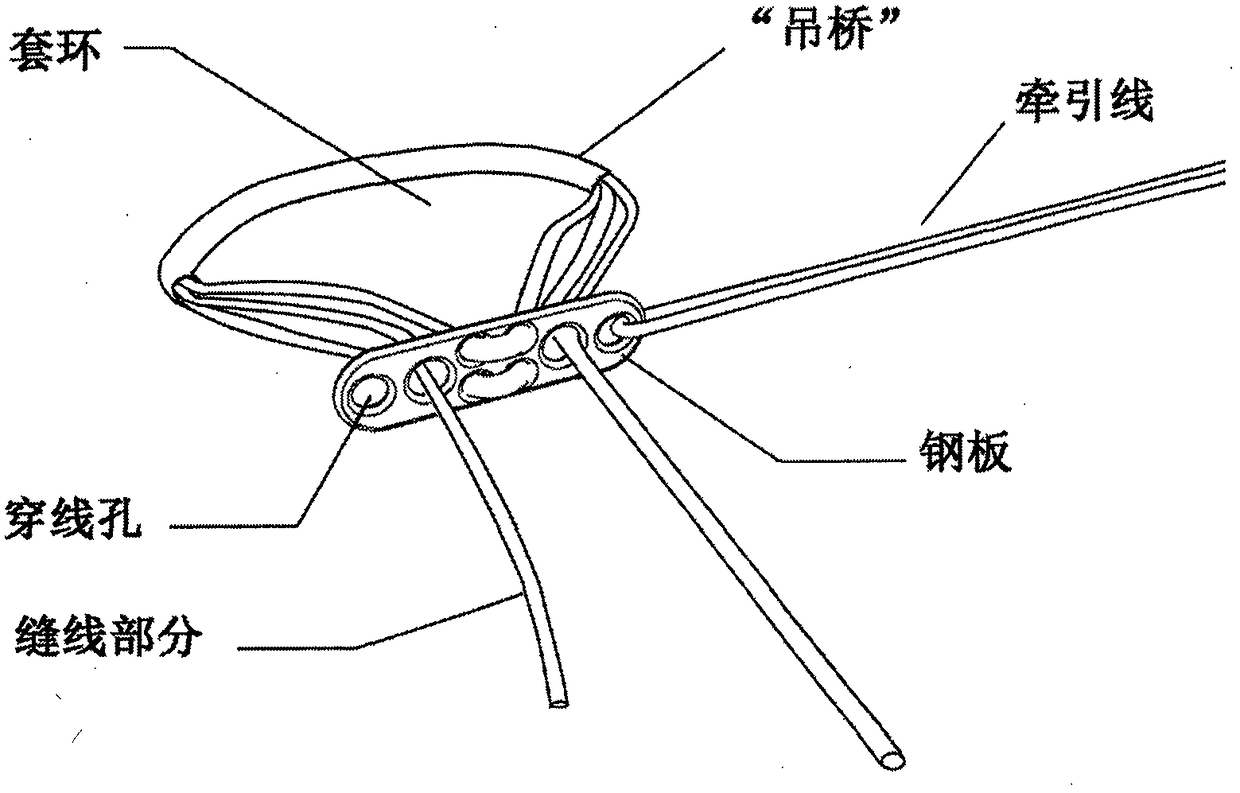 An adjustable collar plate for securing soft tissue or ligament grafts