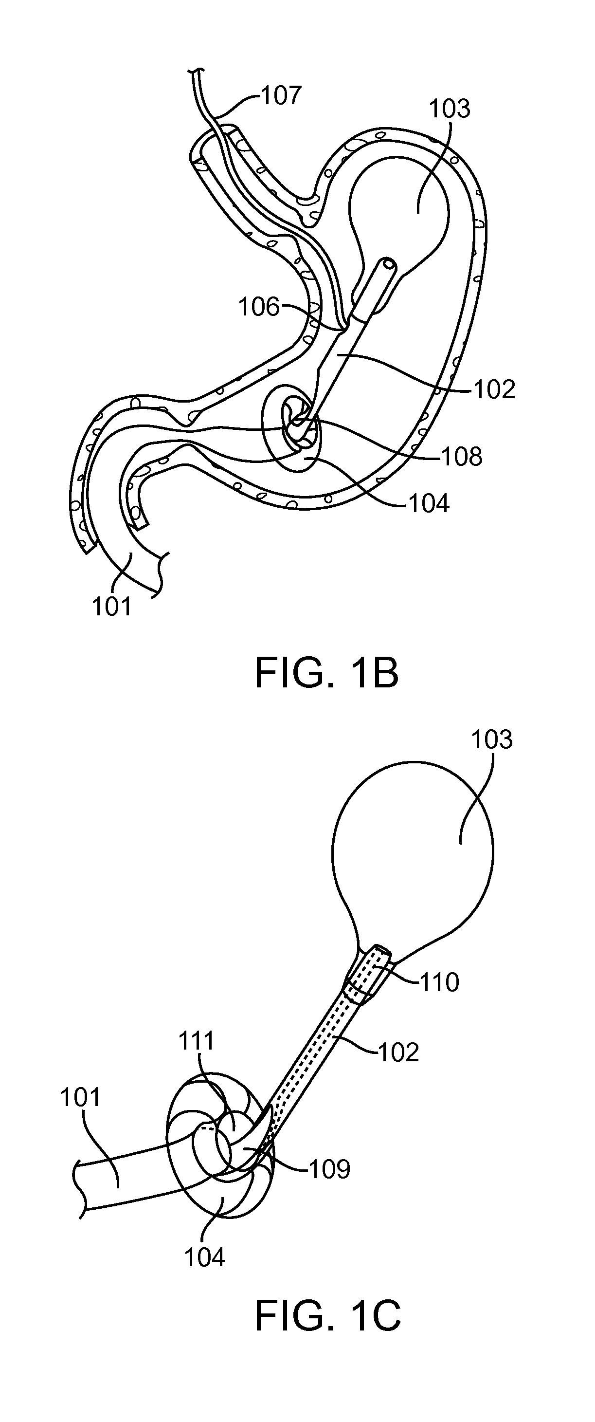 Intragastric implant devices