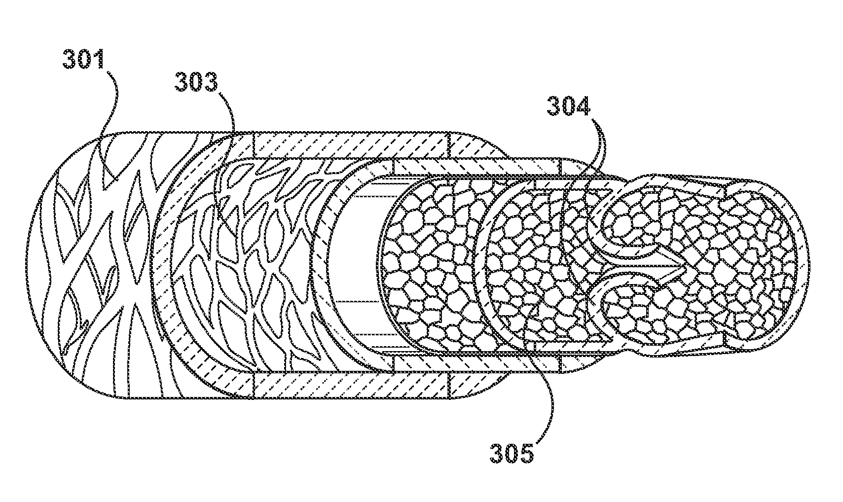 Percutaneous Methods and Apparatus for Creating Native Tissue Venous Valves